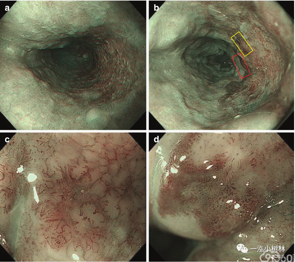 上消化道肿瘤内镜治疗策略系列之早期食管癌二(mm-sm1)