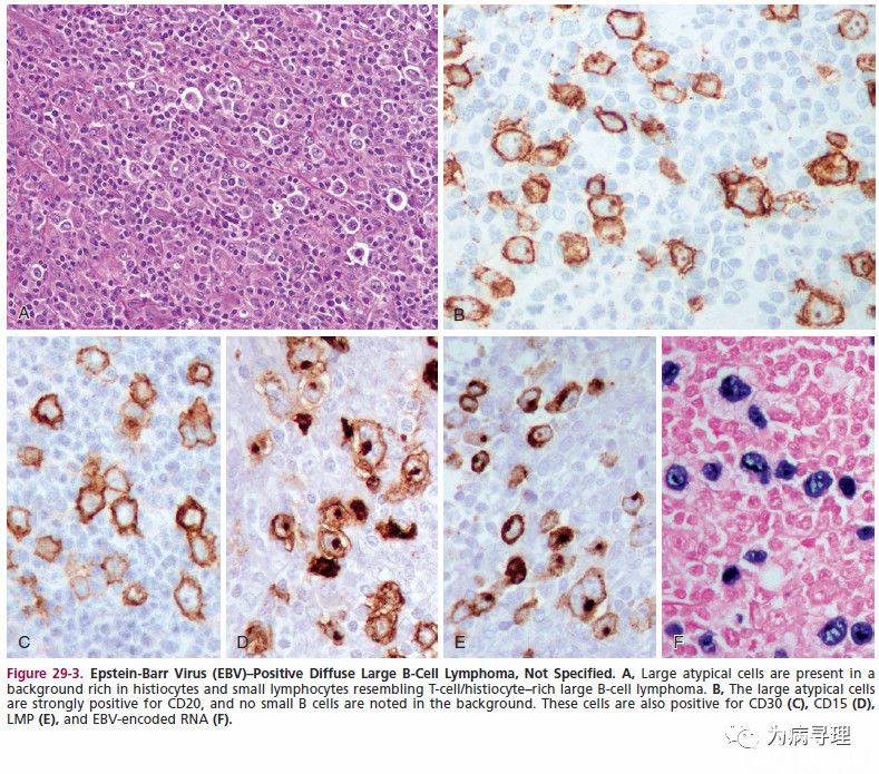 非特指型ebv阳性弥漫大b细胞淋巴瘤