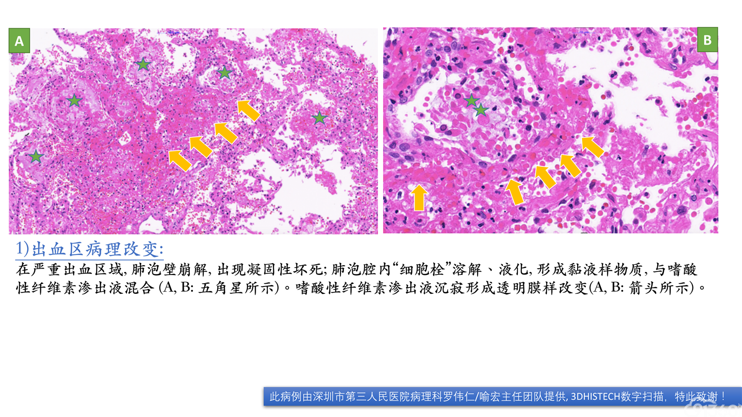 病毒性肺炎的临床和病理特征