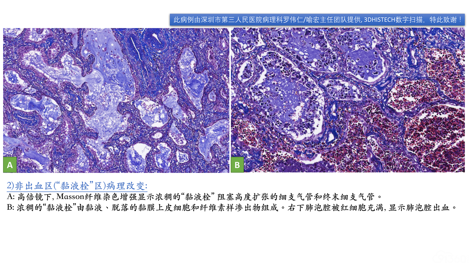 病毒性肺炎的临床和病理特征