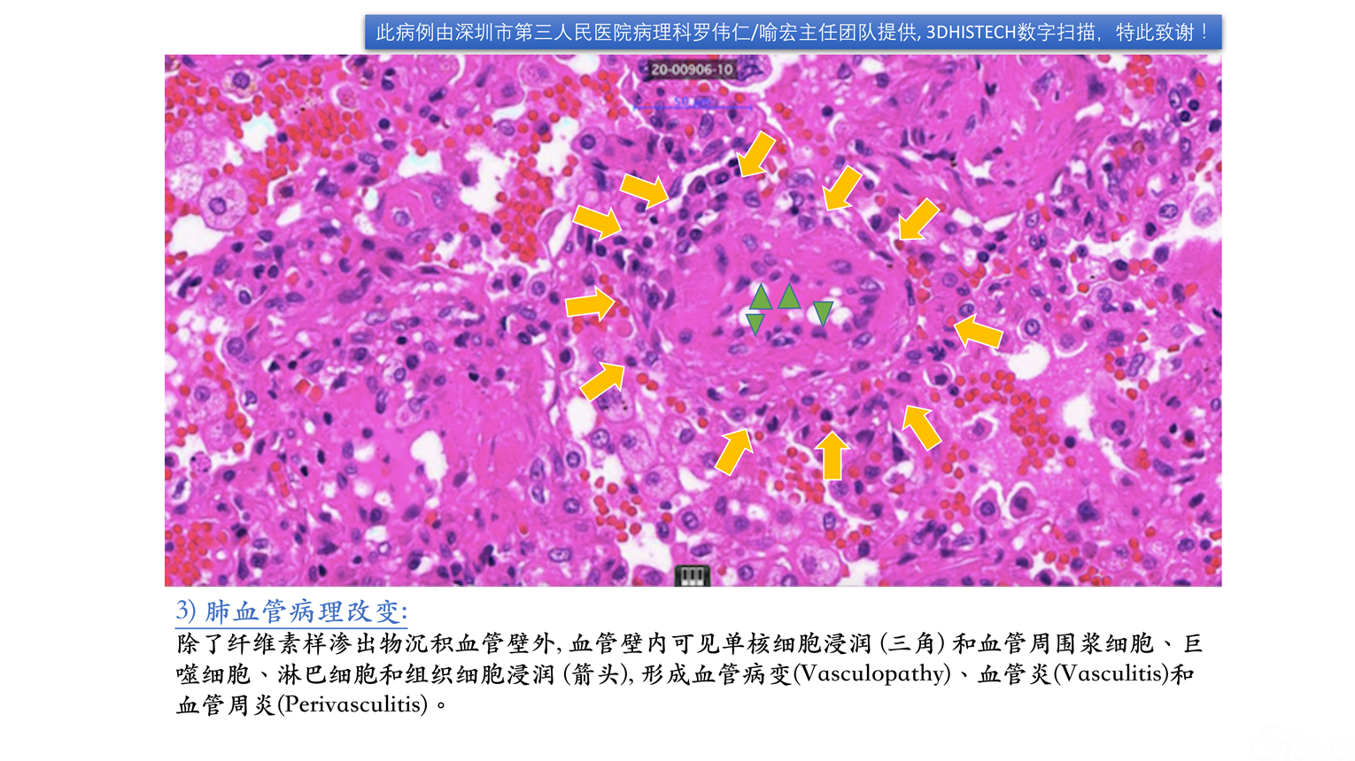 病毒性肺炎的临床和病理特征