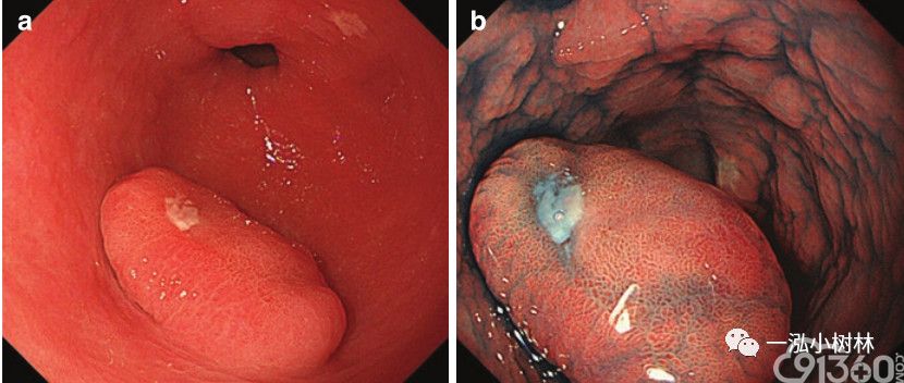 胃息肉内镜诊断与治疗策略