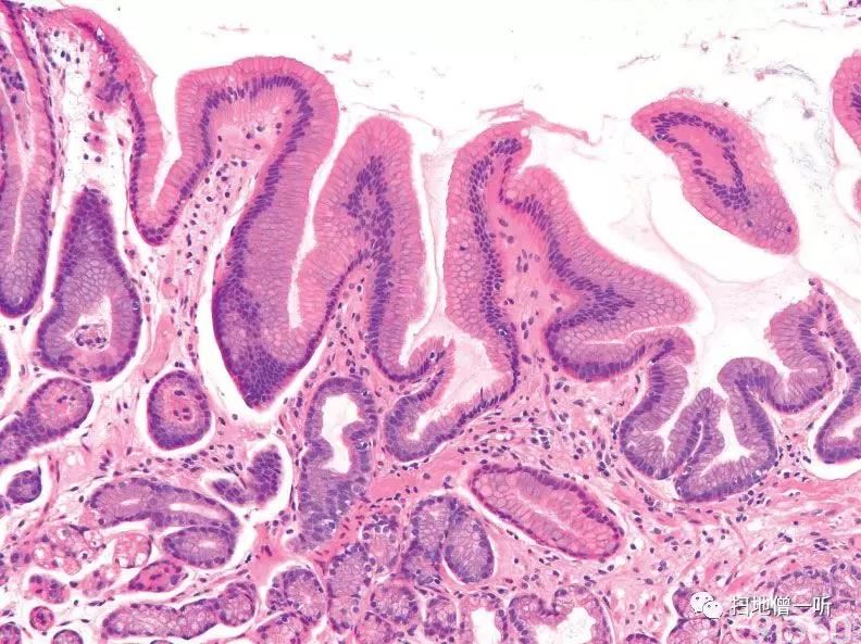医学美图胃良性上皮性息肉病理