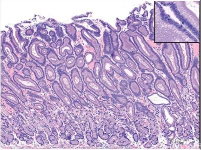医学美图:胃型腺瘤由来的低异性度癌