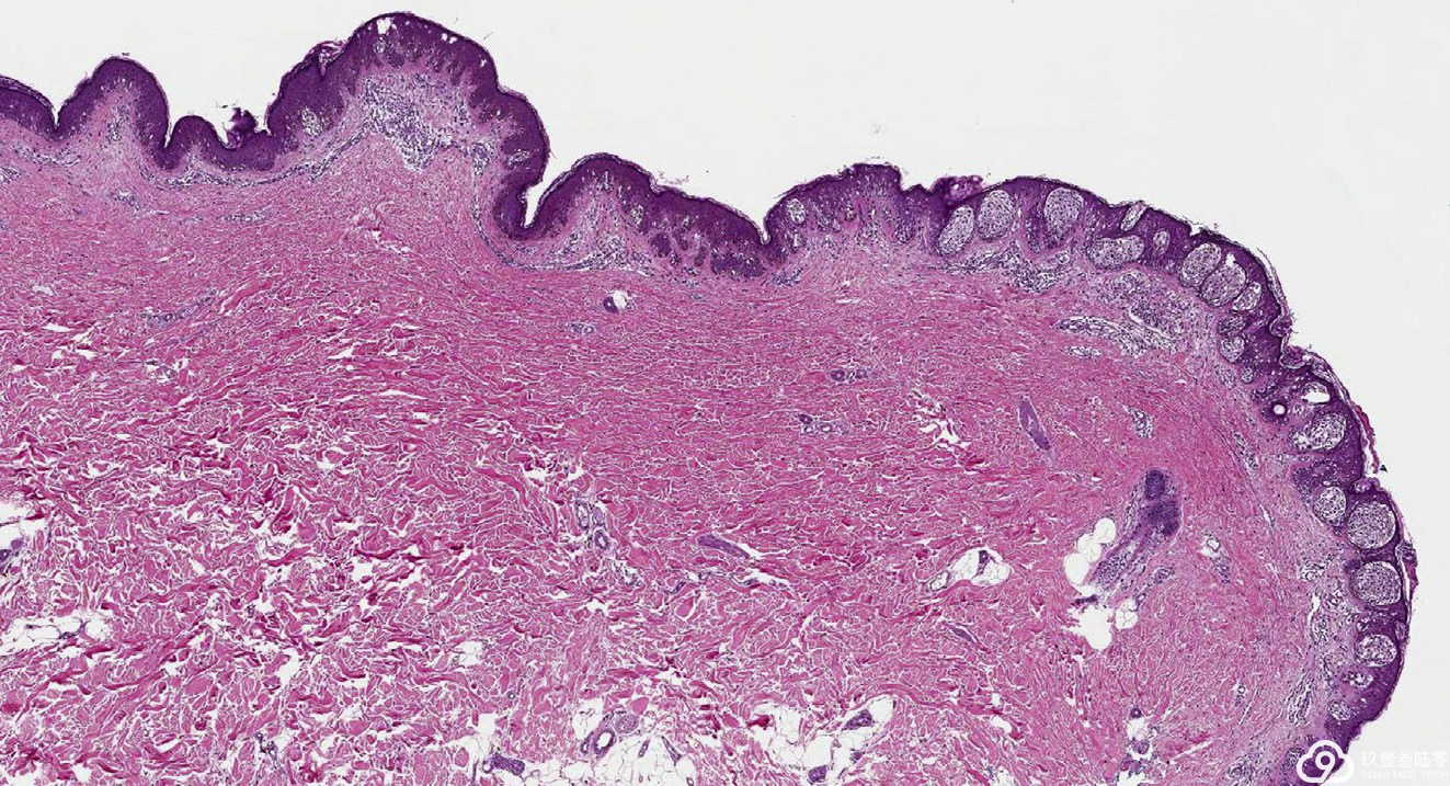 大巢状黑色素瘤:12例临床病理学,形态学和细胞遗传学分析