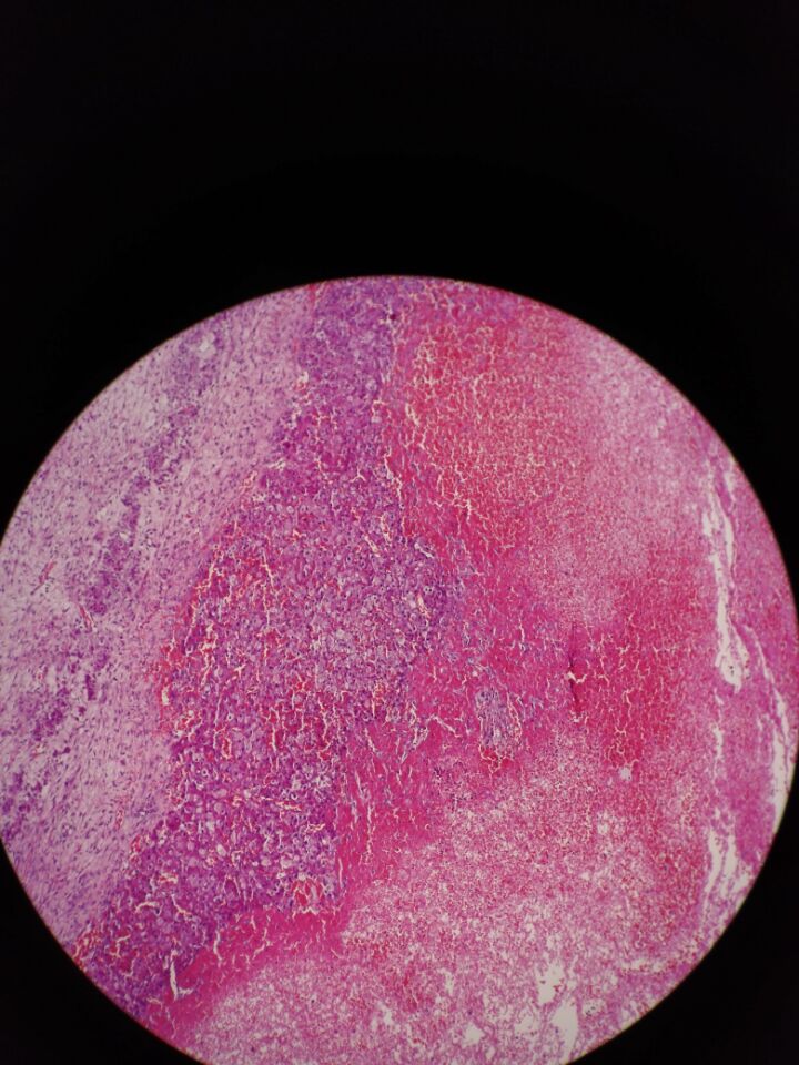 女,40,黄体囊肿伴出血 - 乳腺和女性生殖系统 - 91360病理论坛