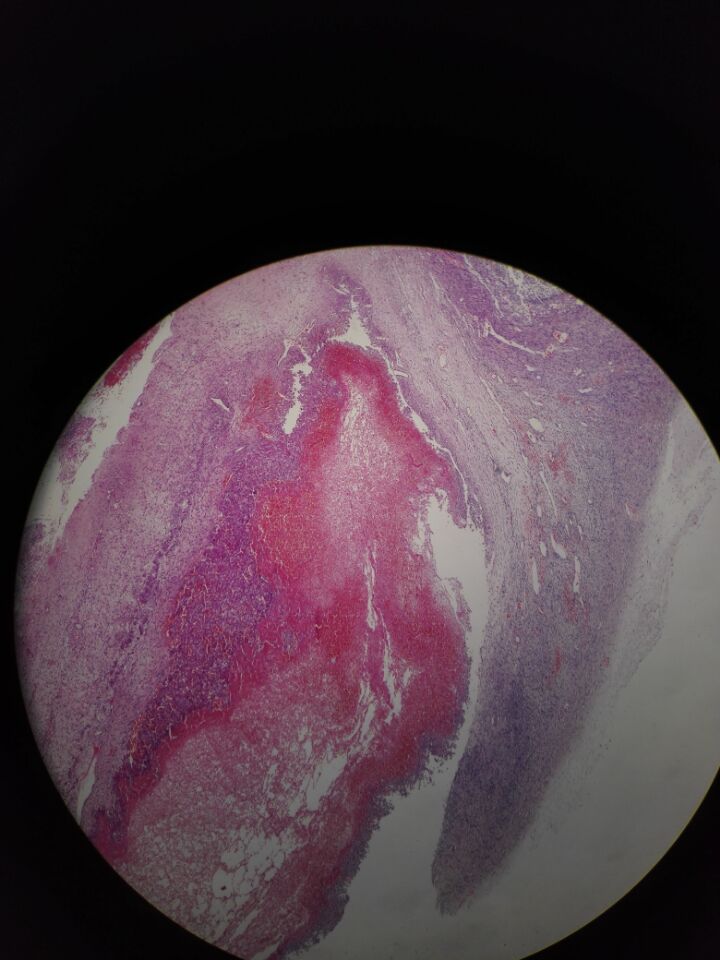 女,40,黄体囊肿伴出血 - 乳腺和女性生殖系统 - 91360病理论坛