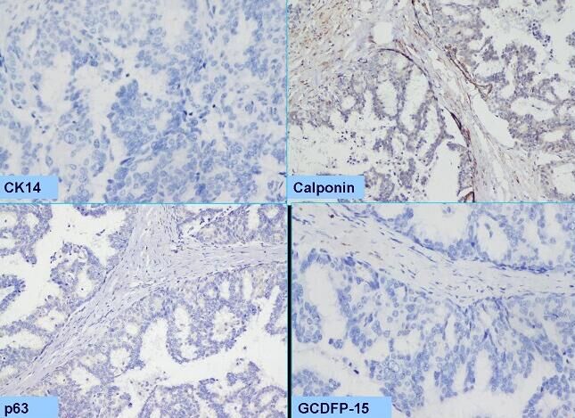 CK14  Calponin p63 GCDFP-15