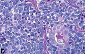 小细胞癌与腺癌