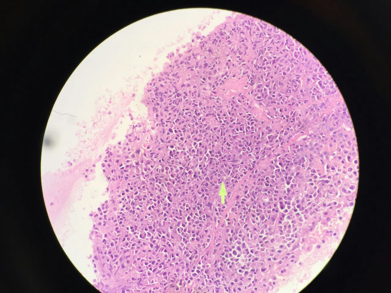 小细胞病变1例,请大家看看.