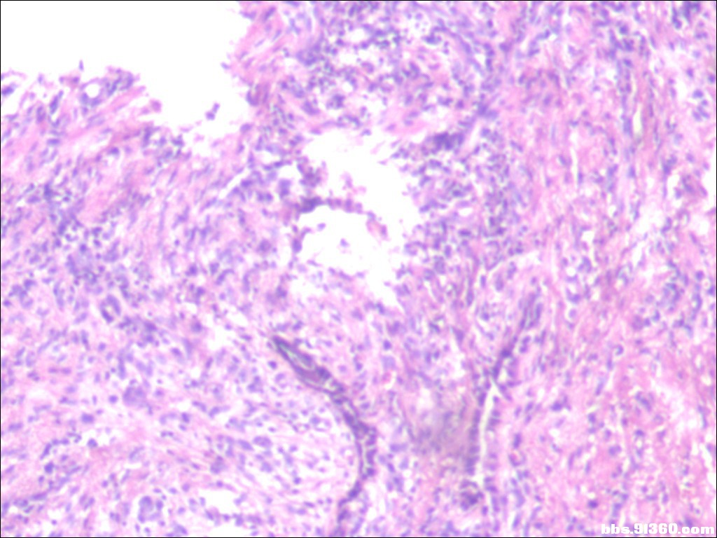 女，35岁，会阴部包块 - 软组织病理 - 91360病理论坛