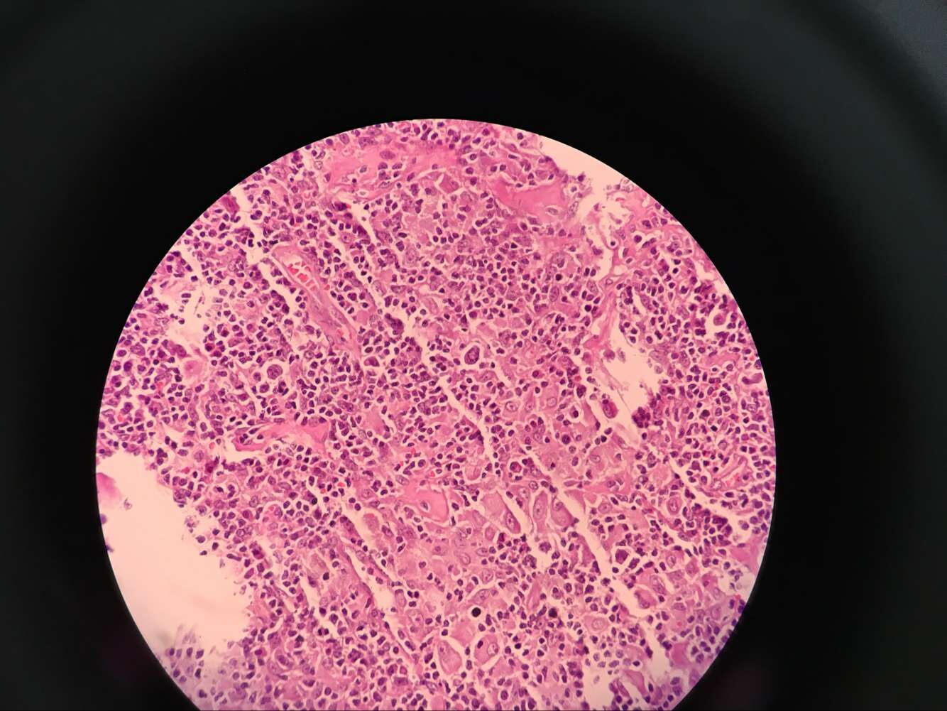 舌根肿物2cm.68岁女