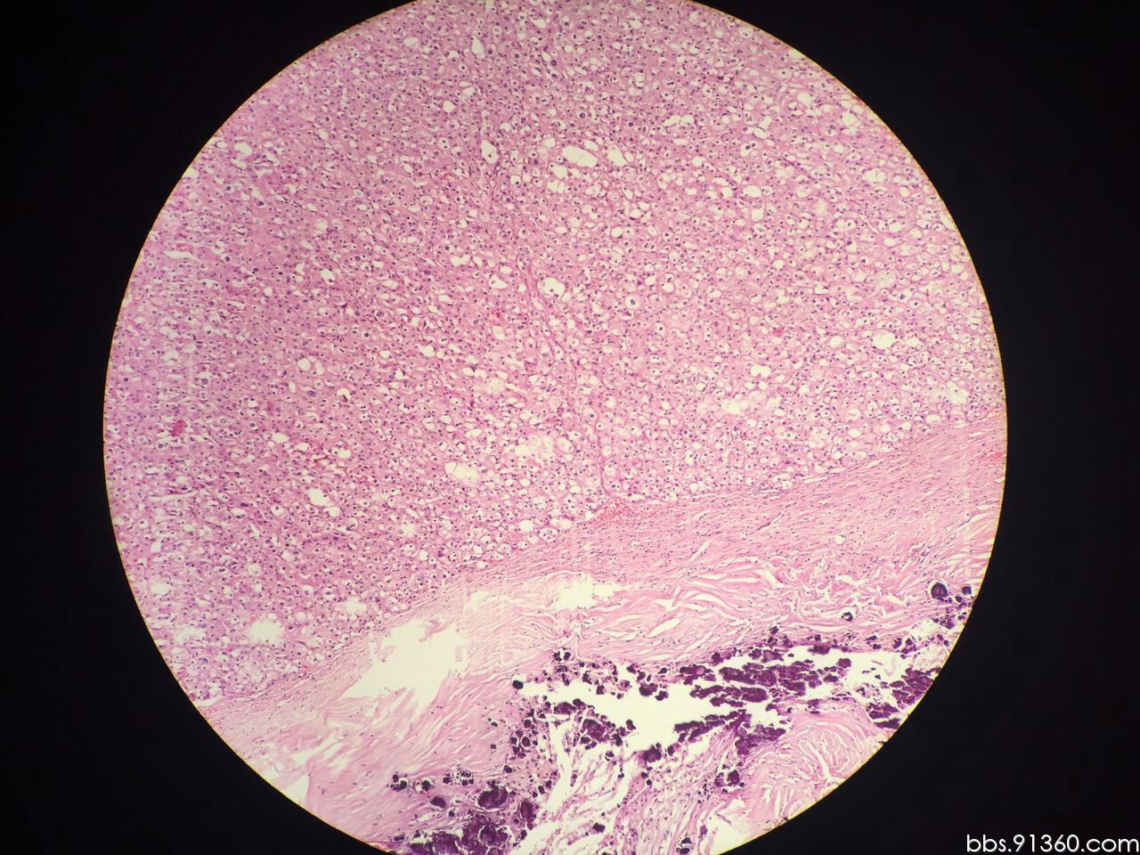 嫌色细胞肾细胞癌讨论2016.3.18【91360泌尿沙龙病例整理20】