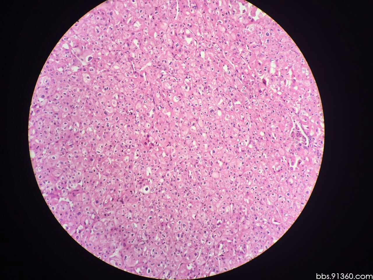 嫌色细胞肾细胞癌讨论2016.3.18【91360泌尿沙龙病例整理20】