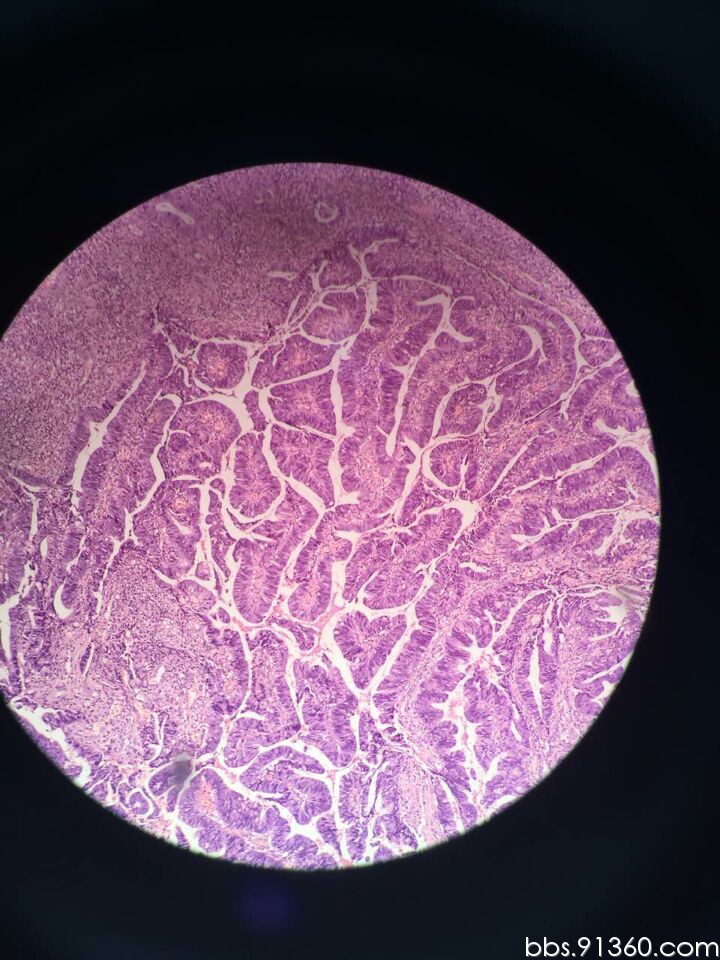 浸润癌案例2016.3.17【91360消化沙龙病例32】