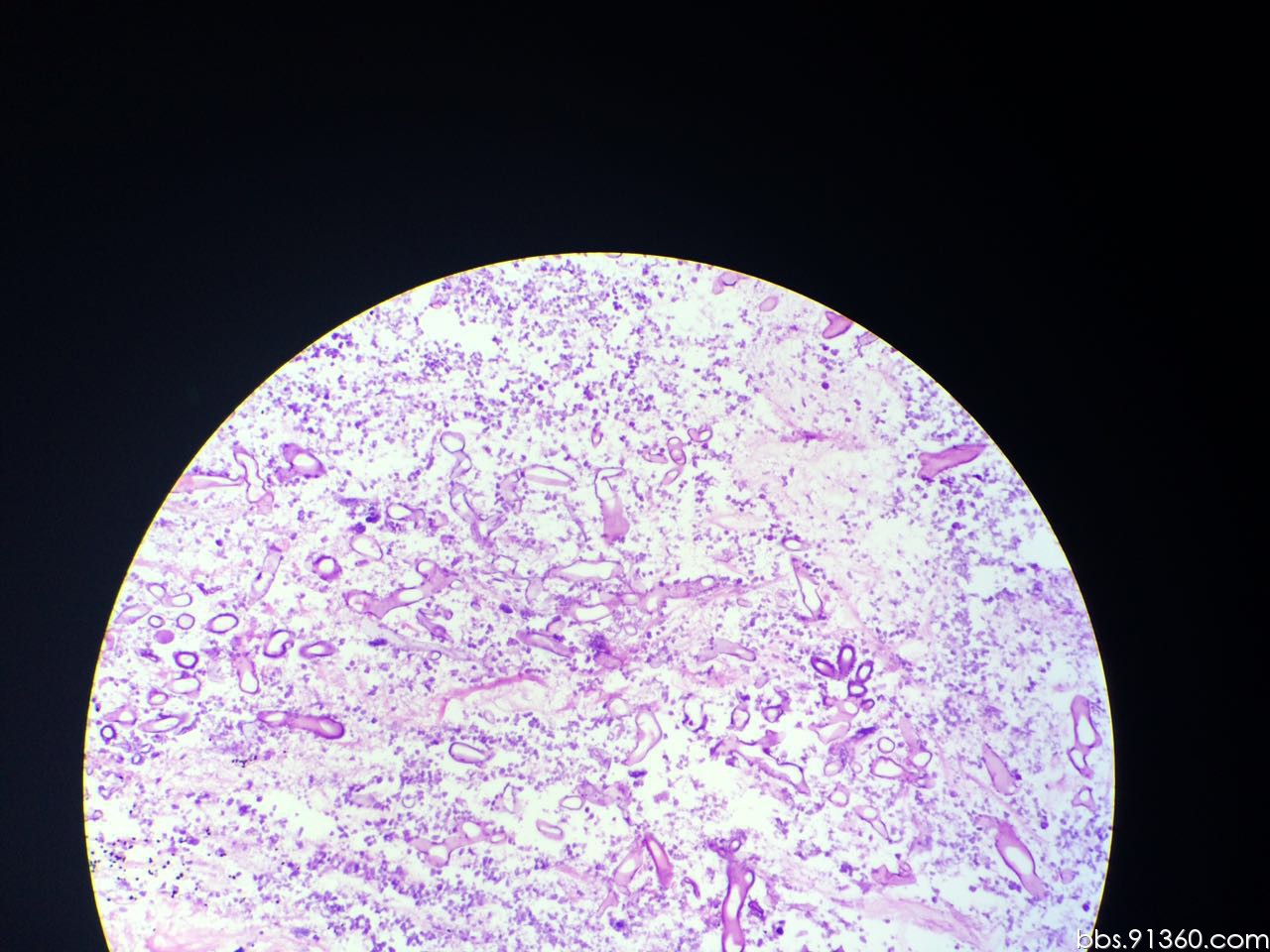 21【91360呼吸沙龙案例14】 - 呼吸系统 - 91360病理论坛