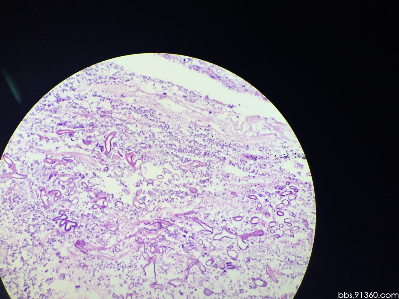 毛霉菌性肺炎病例2016.3.21【91360呼吸沙龙案例14】