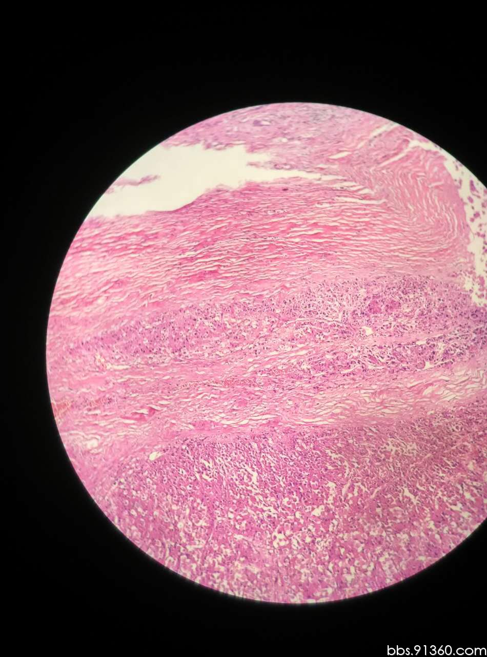 肾上腺皮质癌4.21【91360泌尿沙龙案例56】