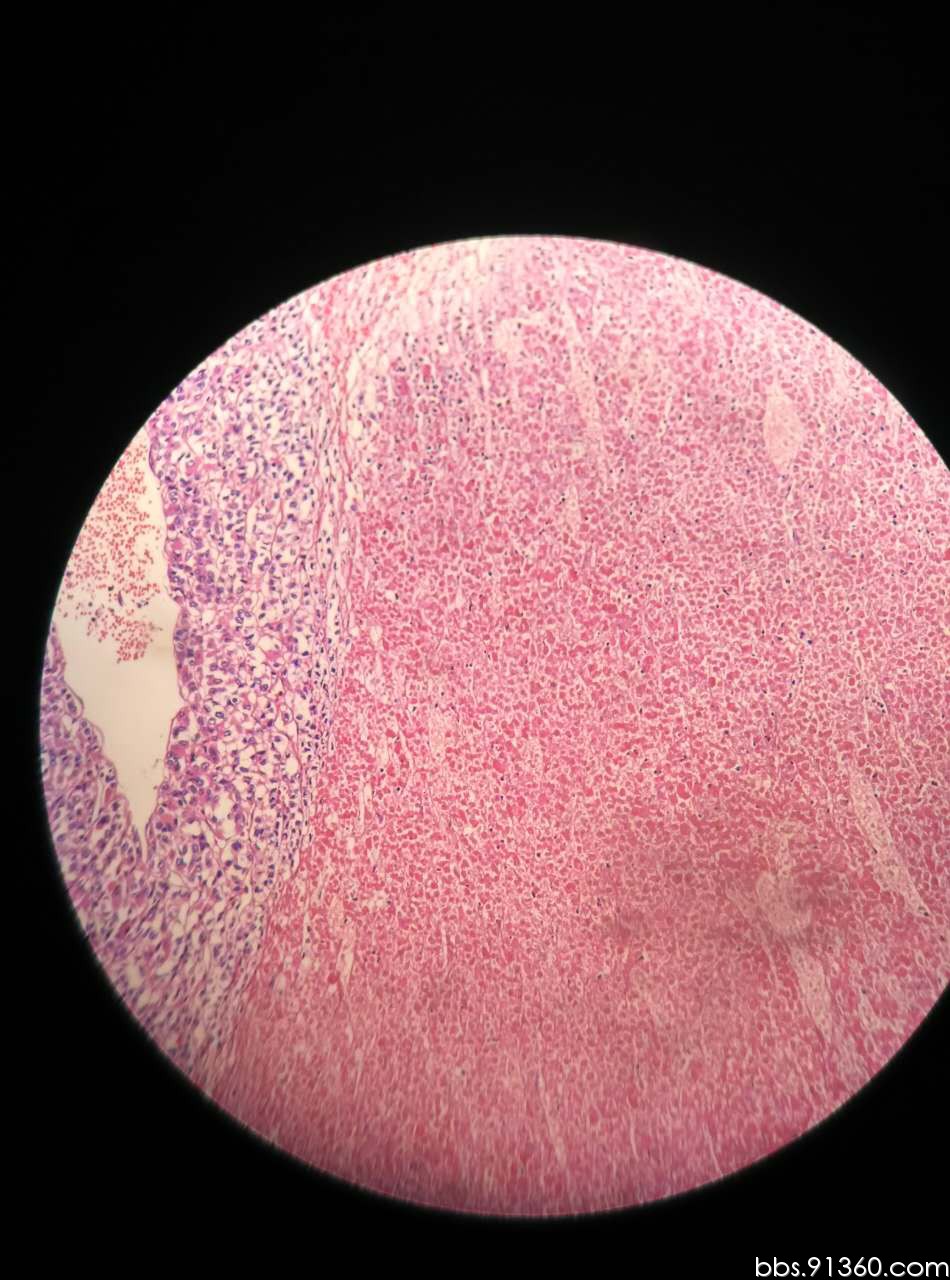 肾上腺皮质癌4.21【91360泌尿沙龙案例56】