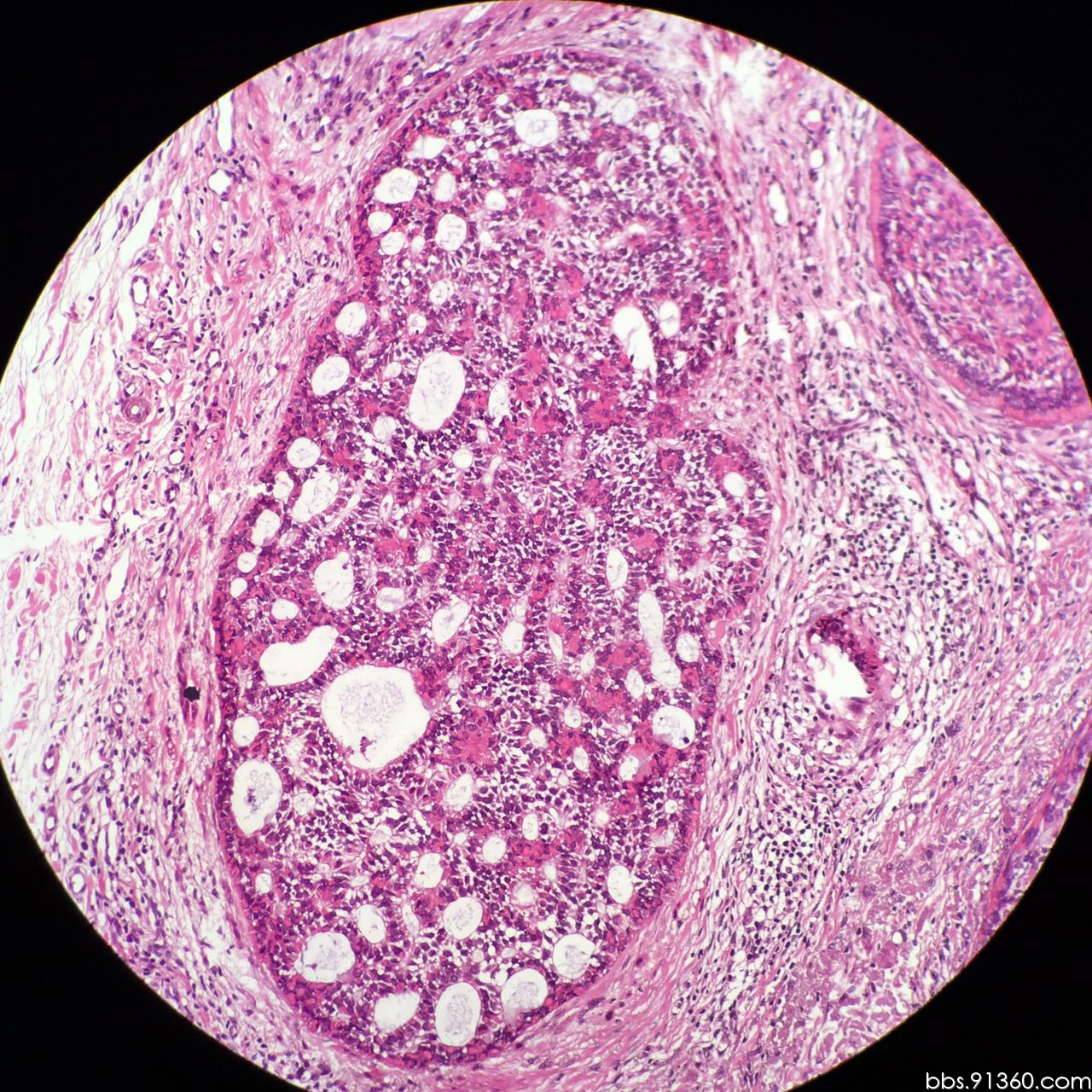 毛母细胞瘤恶变病例2016.05.04【91360皮肤沙龙案例37】