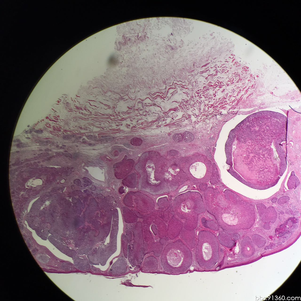 毛母细胞瘤恶变病例2016.05.04【91360皮肤沙龙案例37】