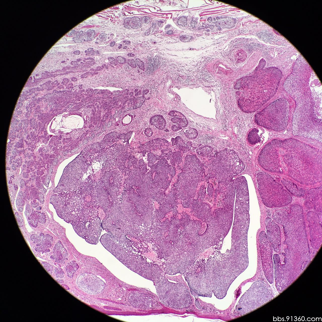 毛母细胞瘤恶变病例2016.05.04【91360皮肤沙龙案例37】