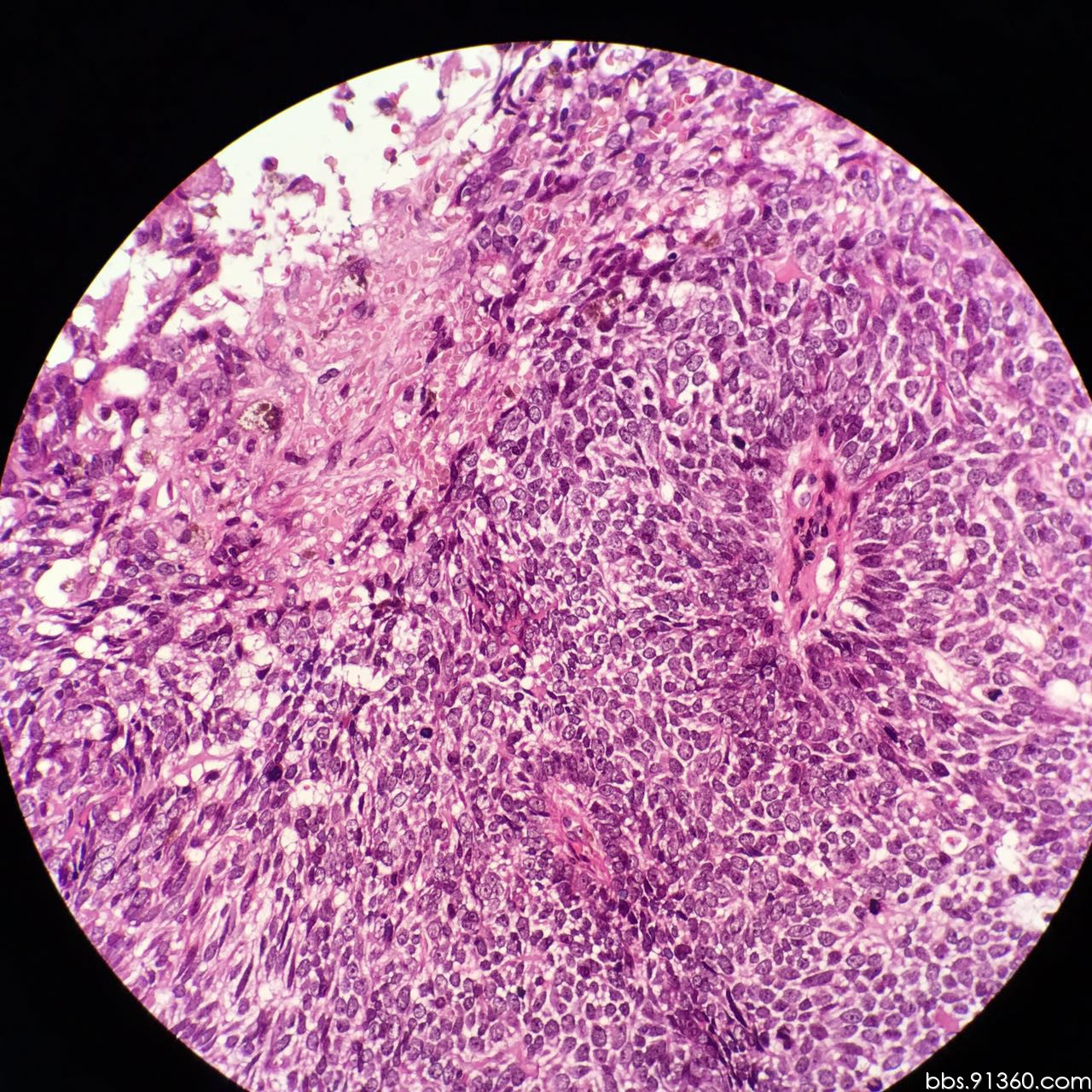 毛母细胞瘤图片