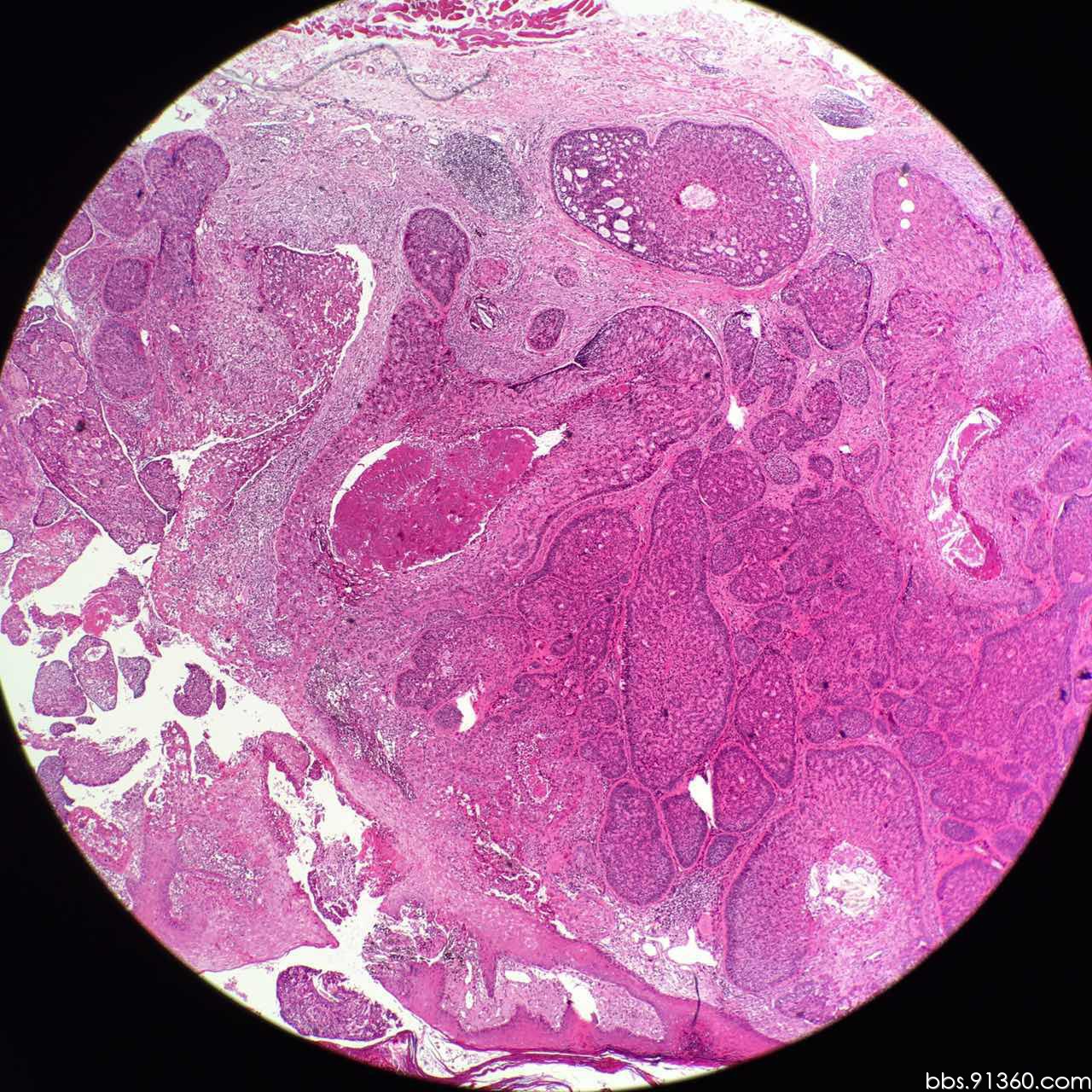 毛母细胞瘤恶变病例2016.05.04【91360皮肤沙龙案例37】