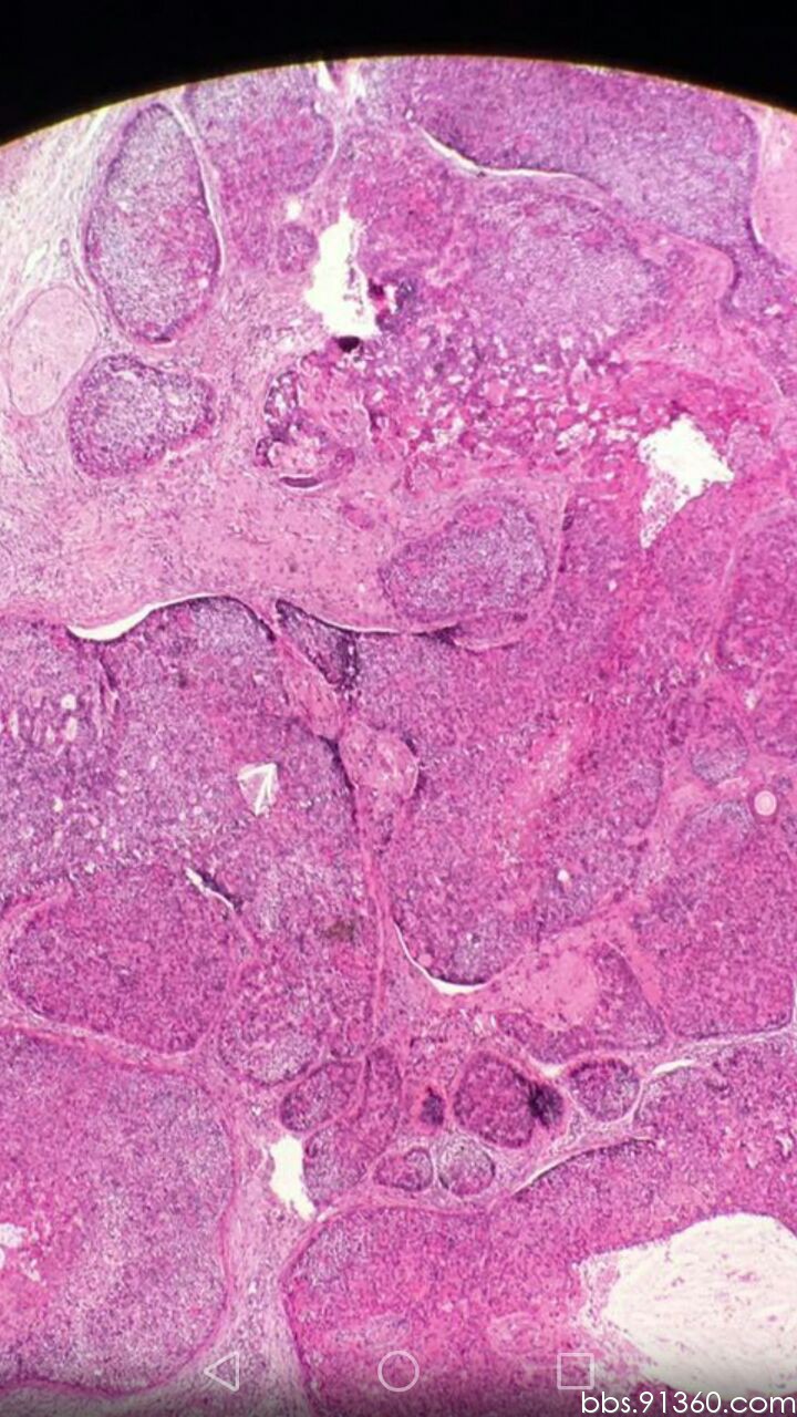 毛母细胞瘤图片