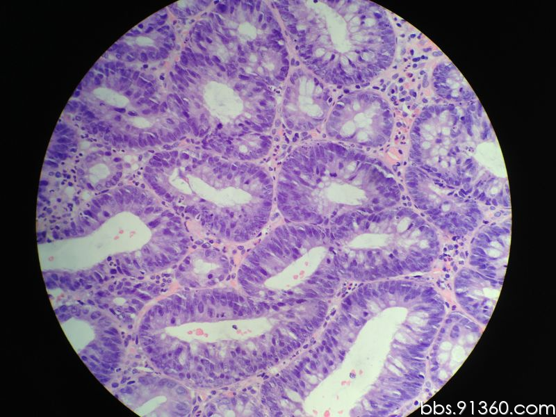 管状腺瘤案例2016.5.18【91360消化沙龙病例99】