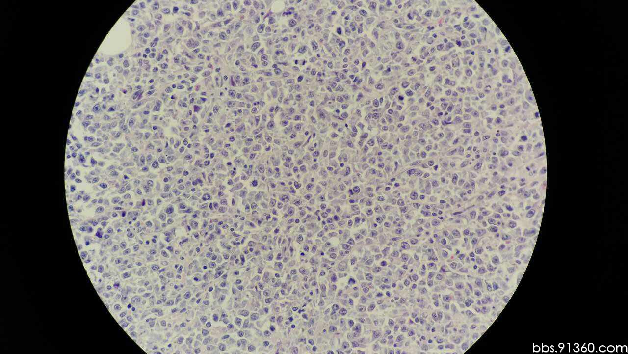 男72岁左睾丸肿物【91360泌尿沙龙69】