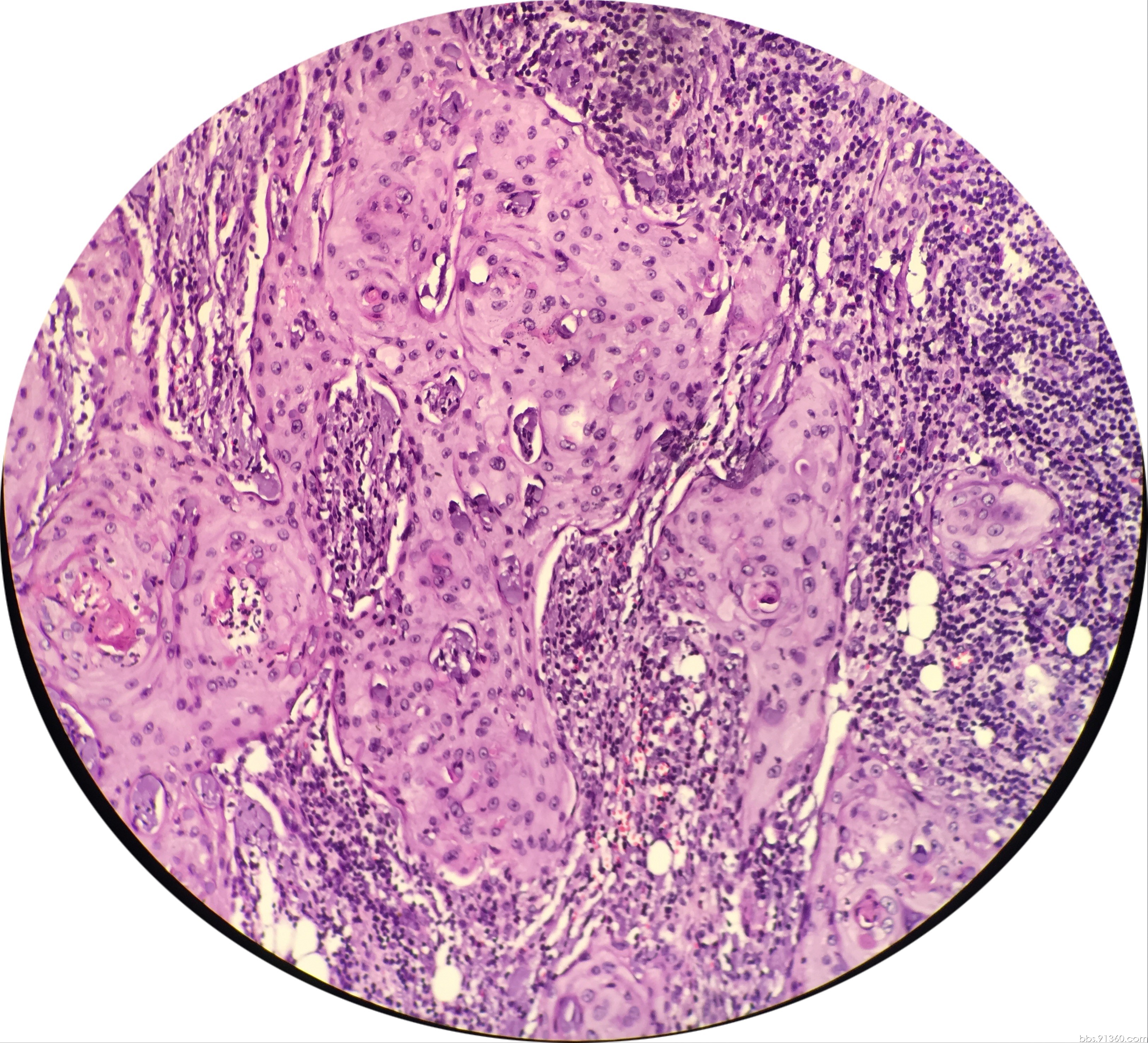 鳞状细胞癌切片图片