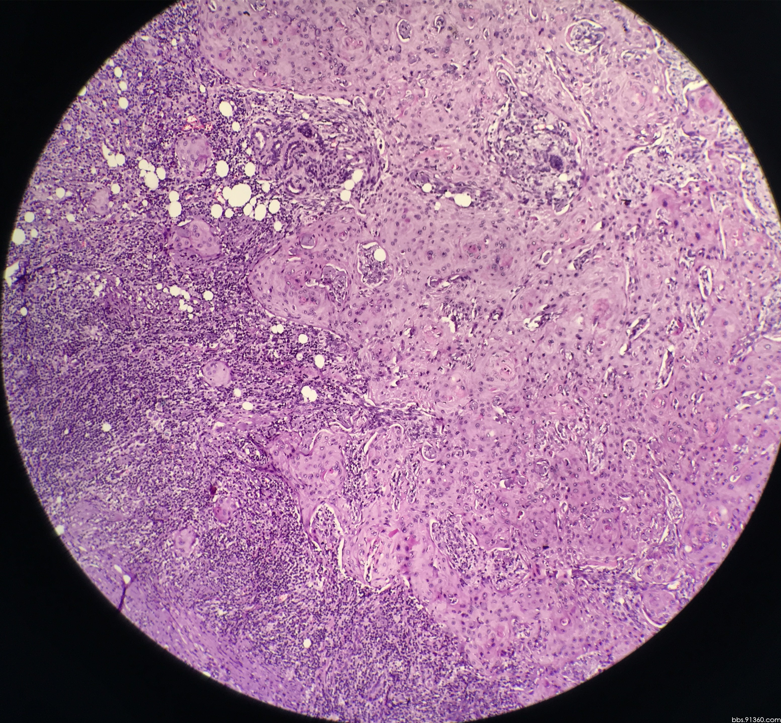 鳞状细胞癌切片图片