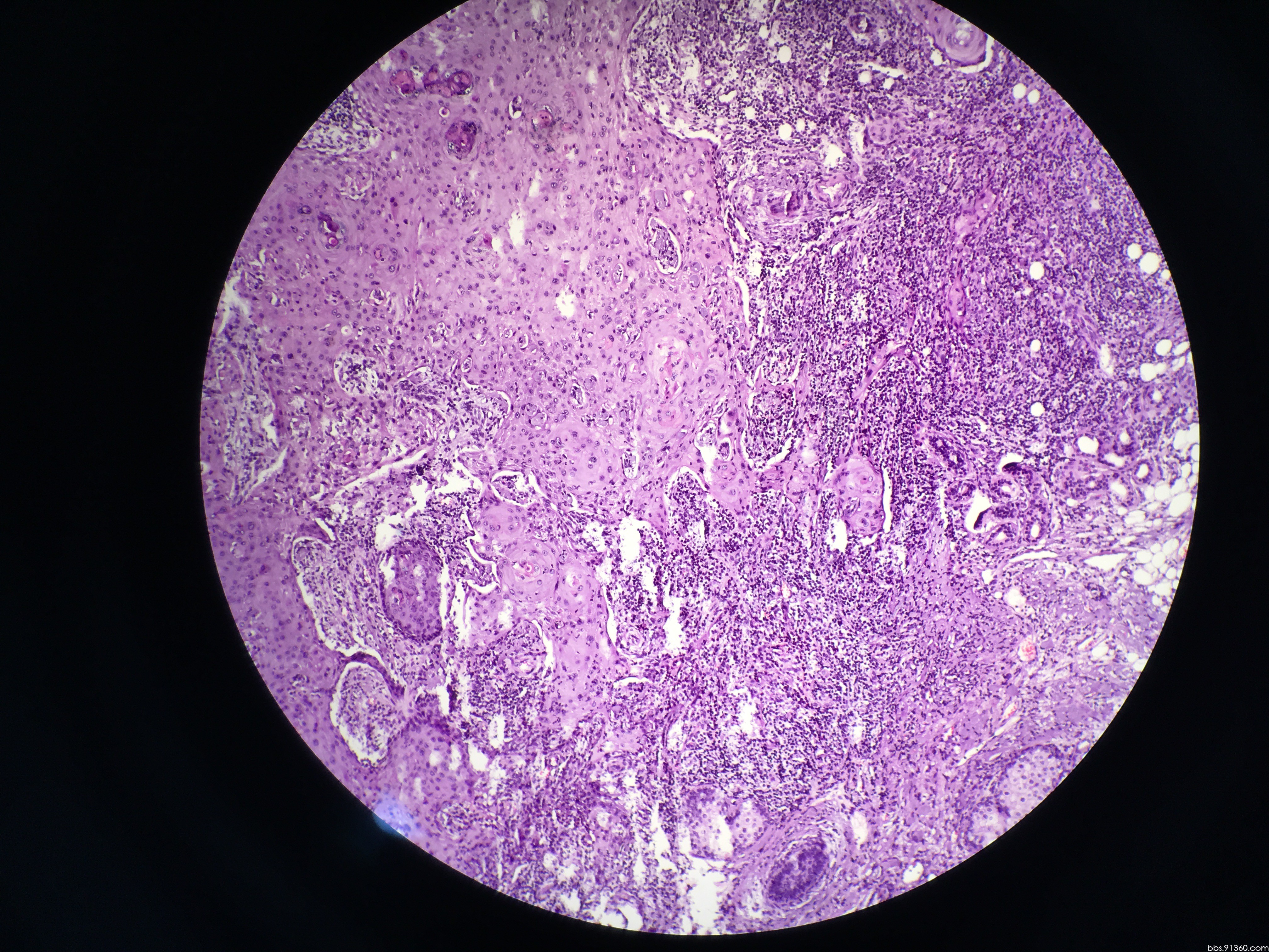 鼻咽鳞状细胞癌图片