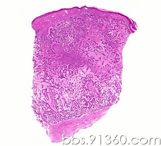 基底细胞癌-结节型.jpg