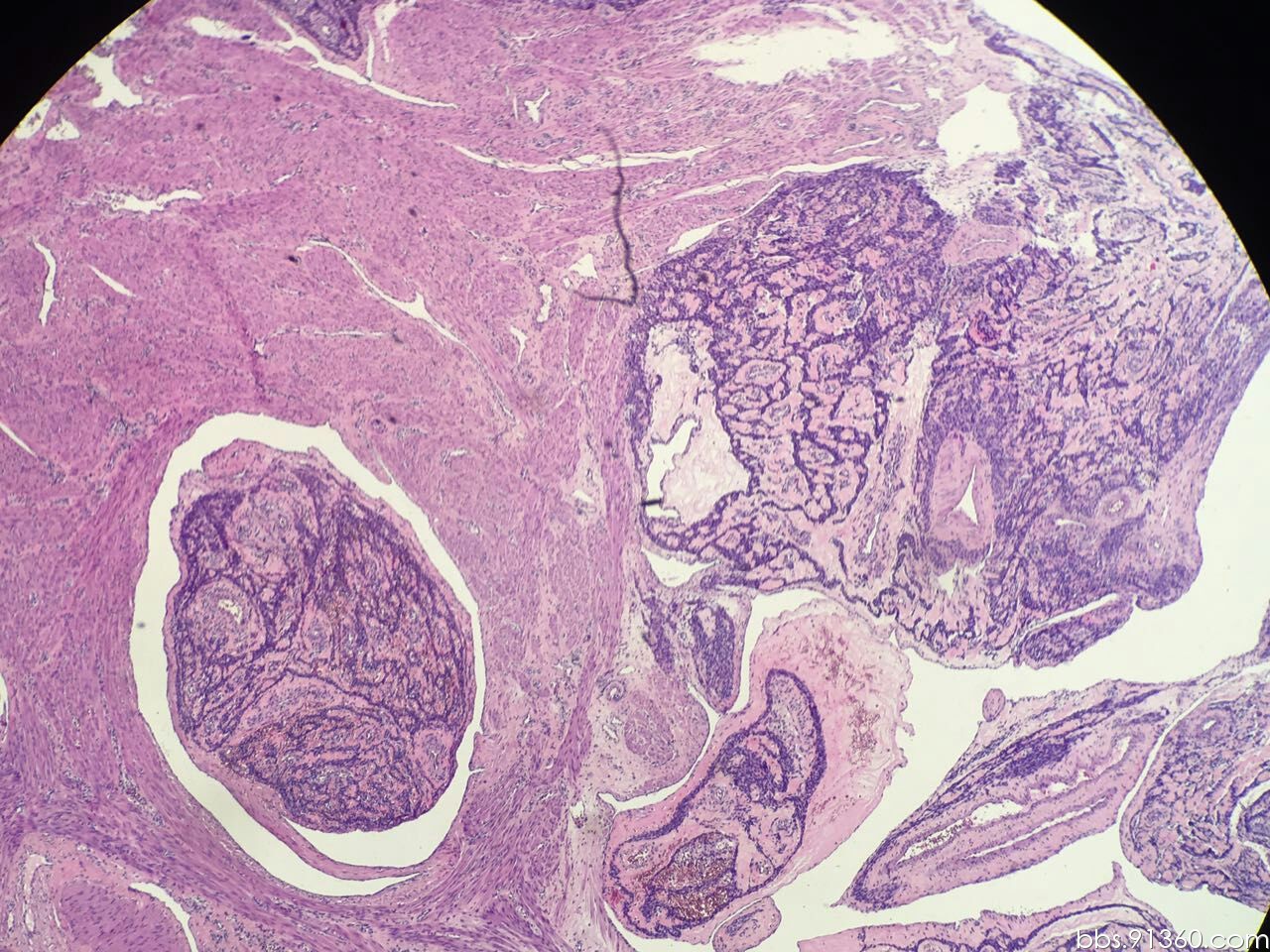 病例4 子宫浆膜下肌瘤-妇产科学-医学