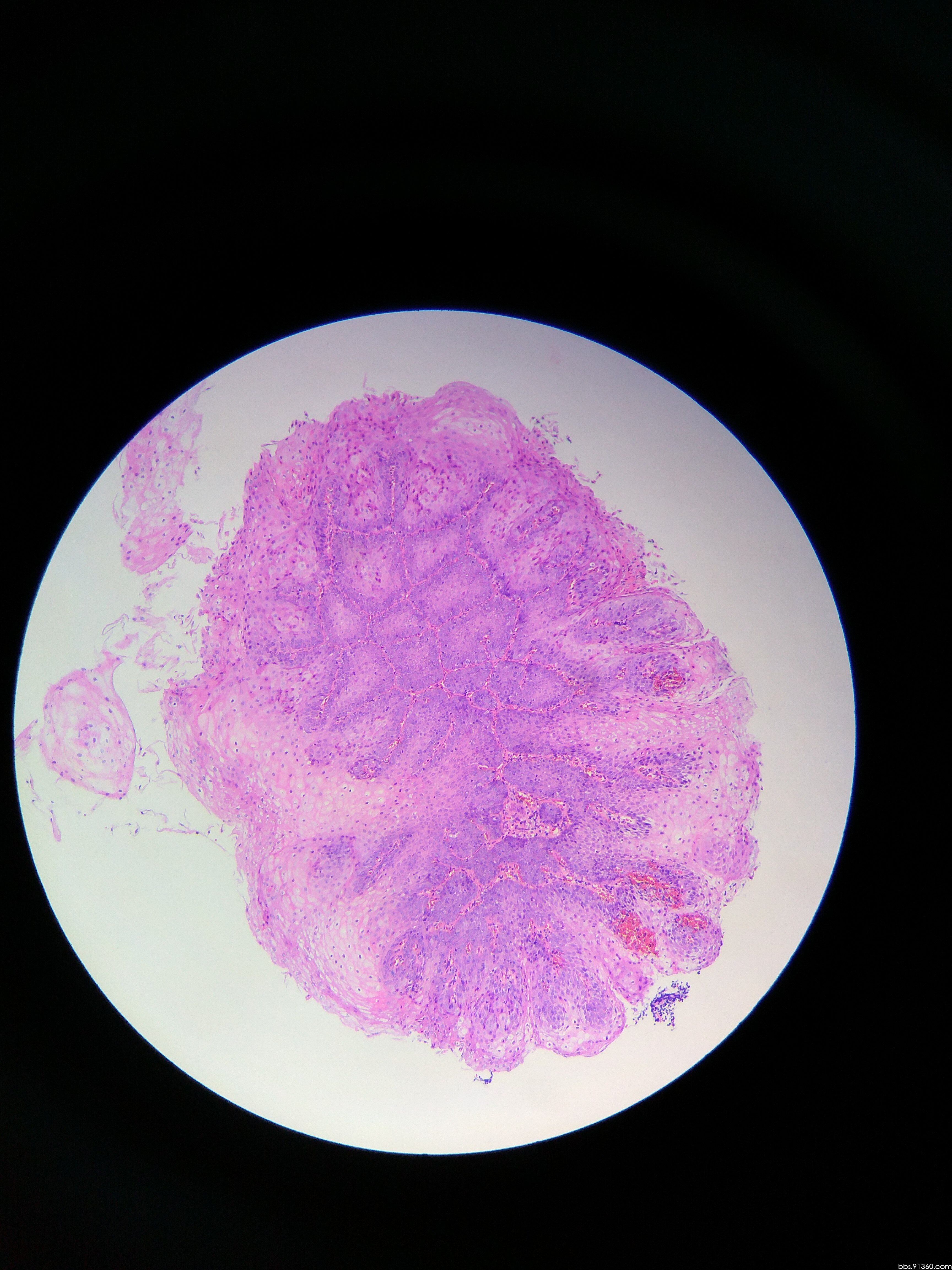 男39岁,食管活检老师们帮忙一下.