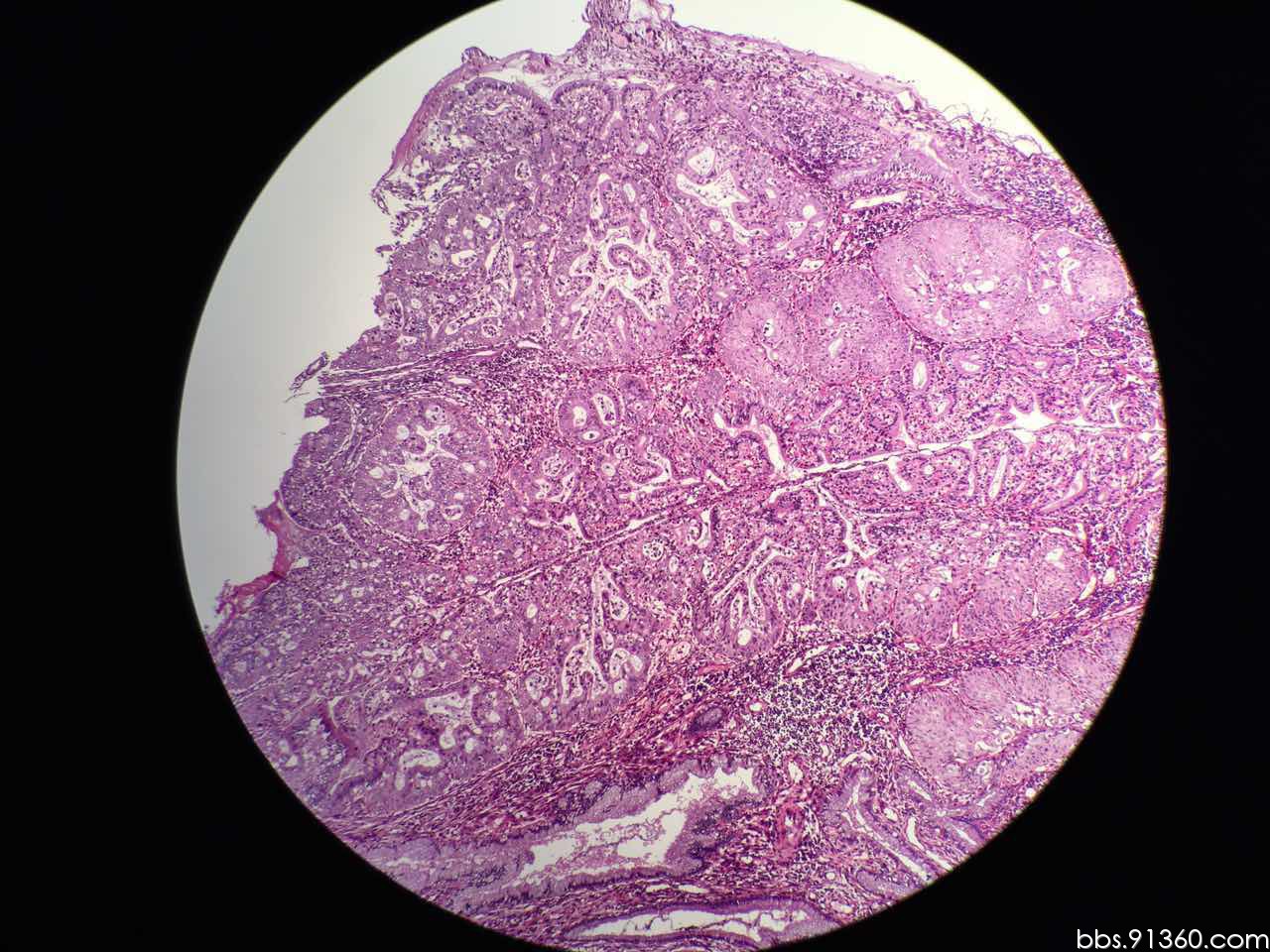 第五节 宫颈管微腺体增生-宫颈腺癌-医学
