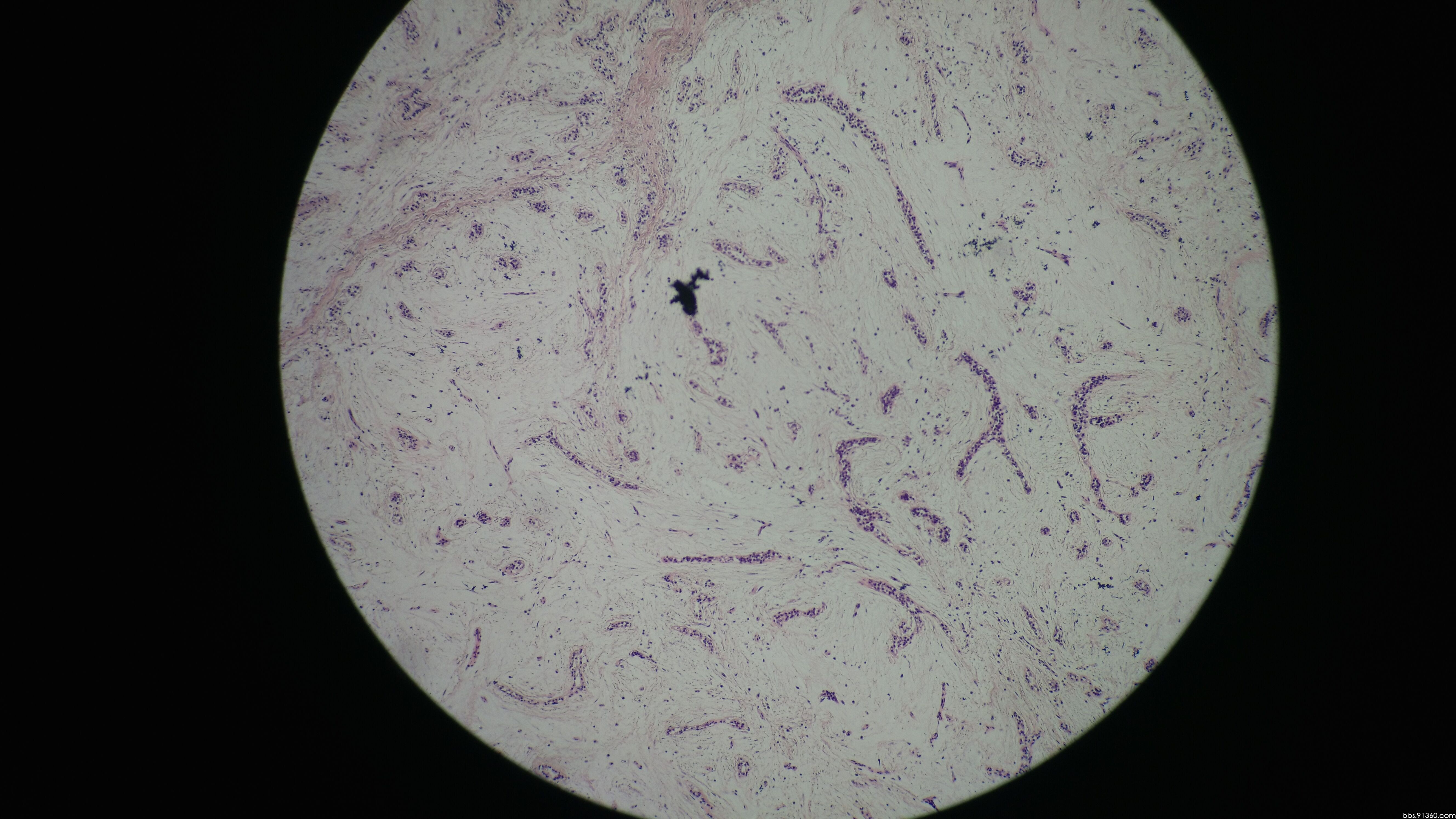 女22岁,这例间质真的是粘液变性.