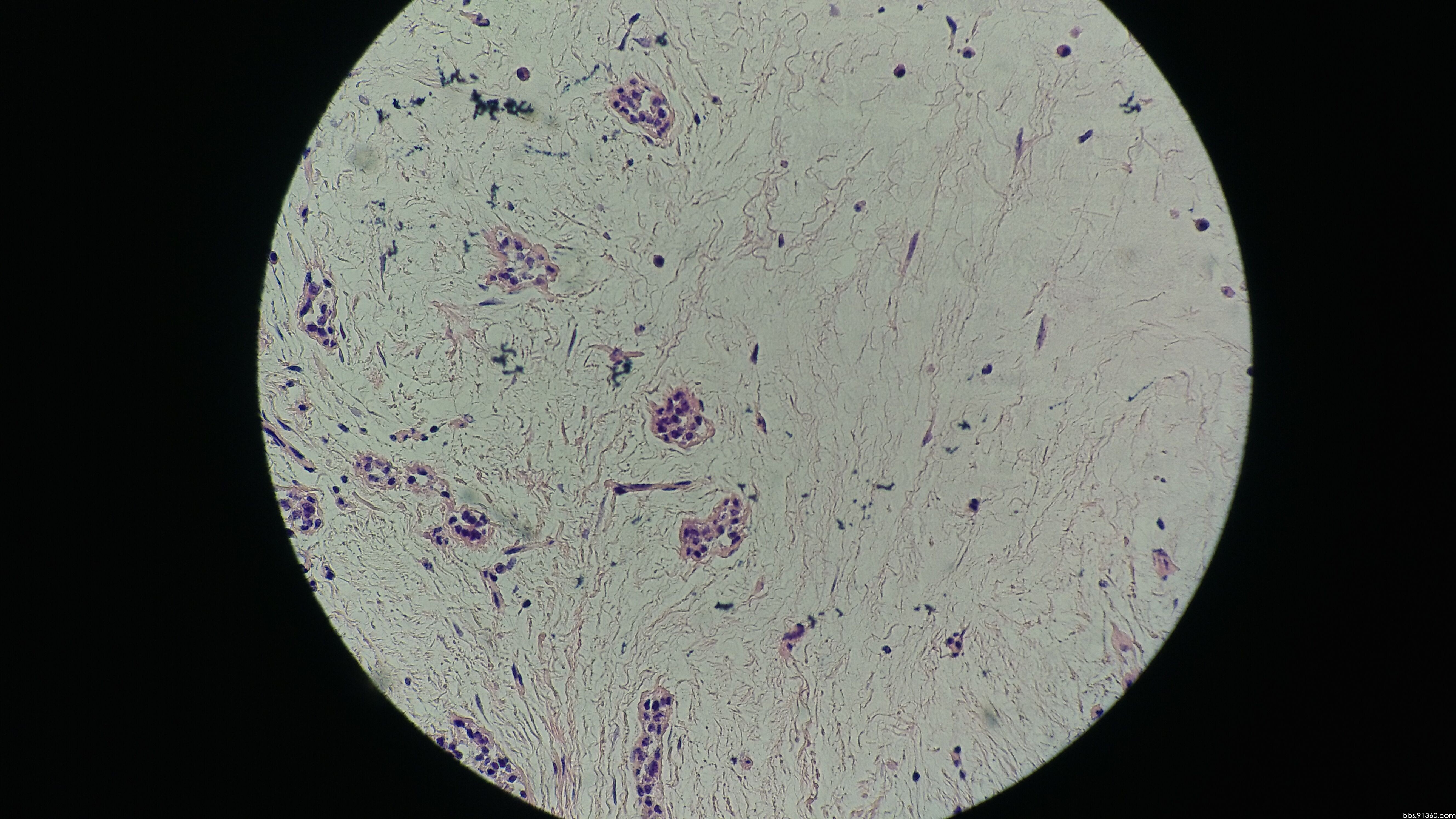 女22岁,这例间质真的是粘液变性.