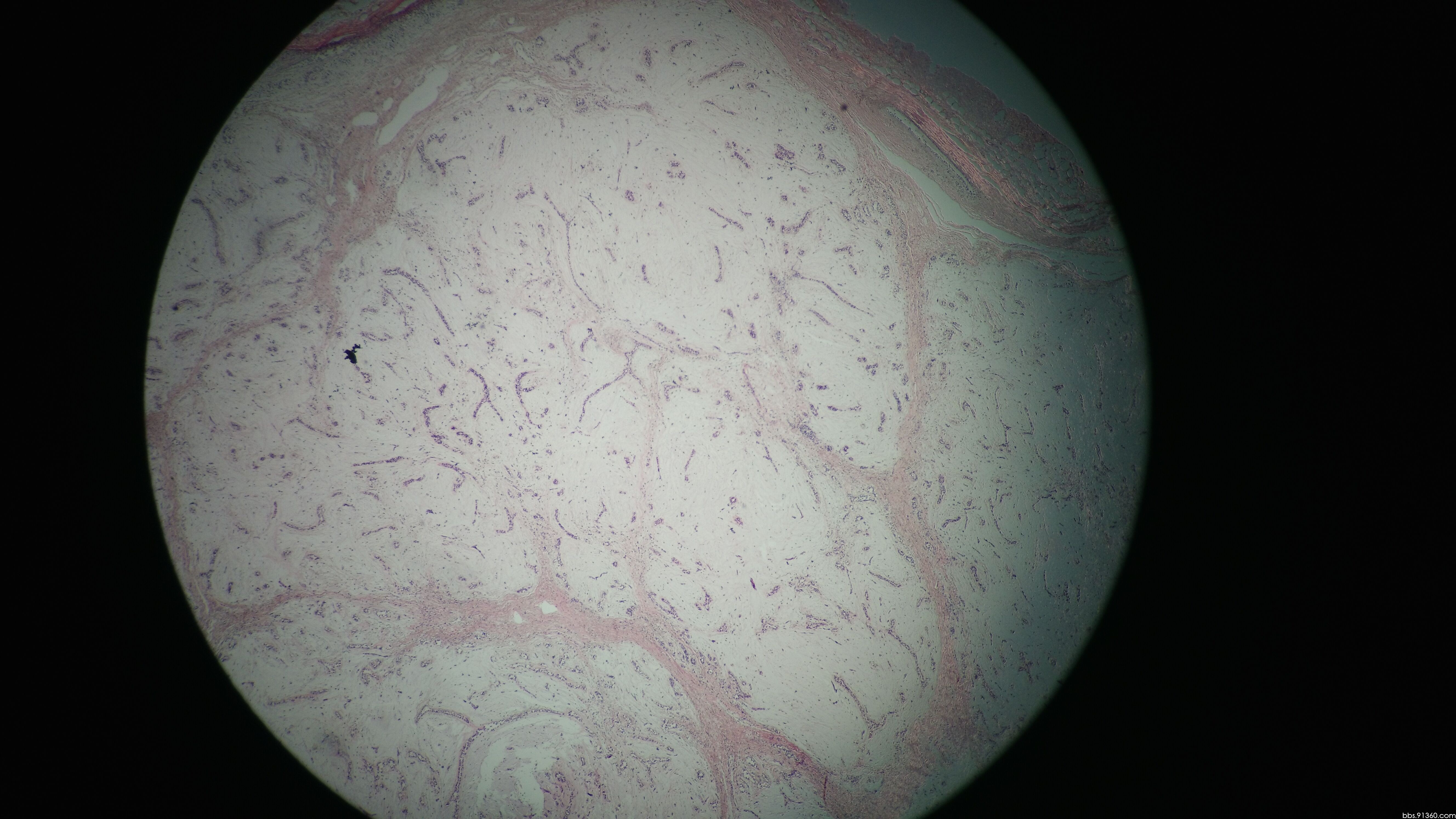 女22岁,这例间质真的是粘液变性.