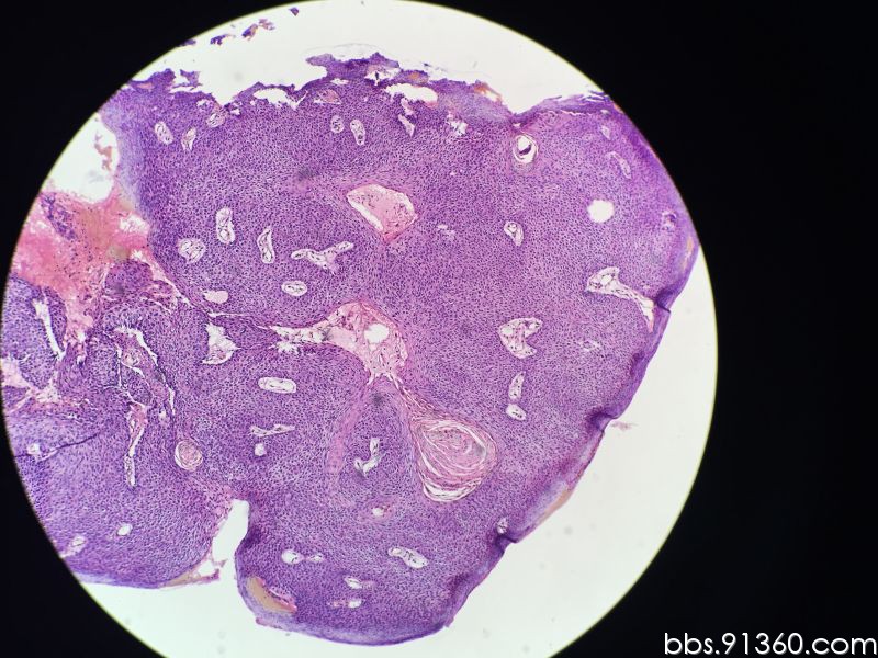 球结膜肿物病例2016.8.1【91360皮肤沙龙病例64】