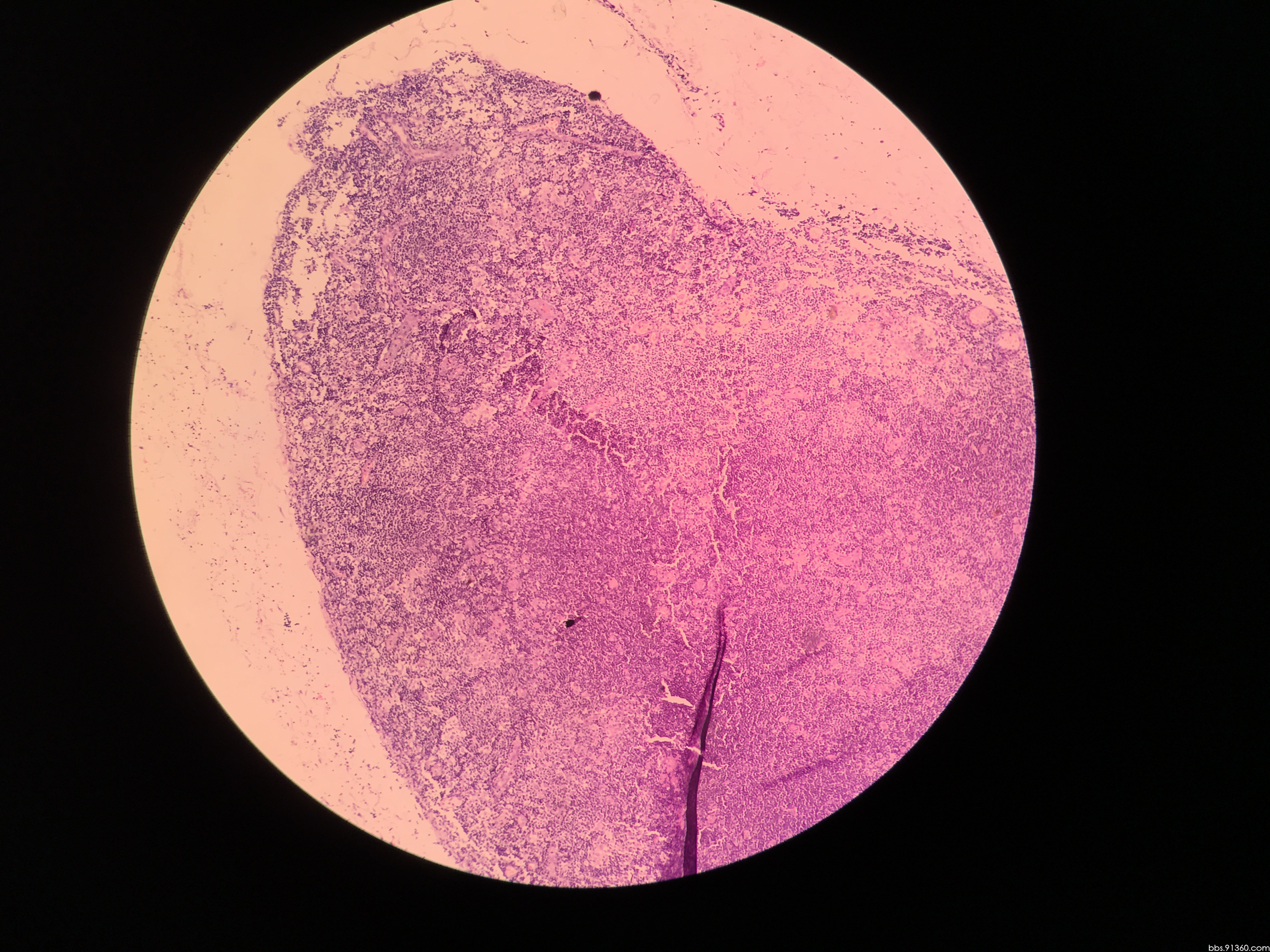 球结膜肿物0.7x0.7x0.2cm,男35岁.大家给看看