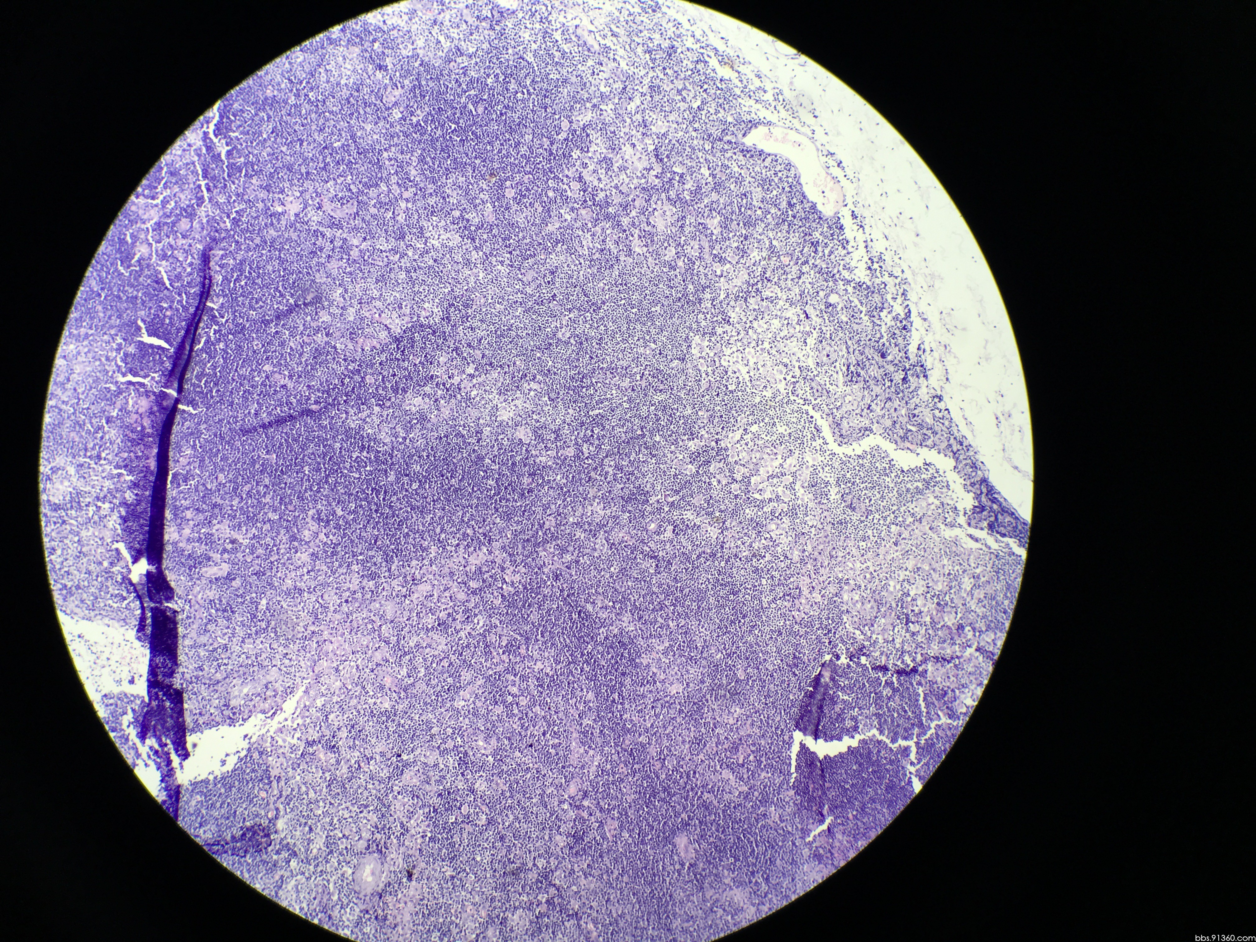 球结膜肿物0.7x0.7x0.2cm,男35岁.大家给看看