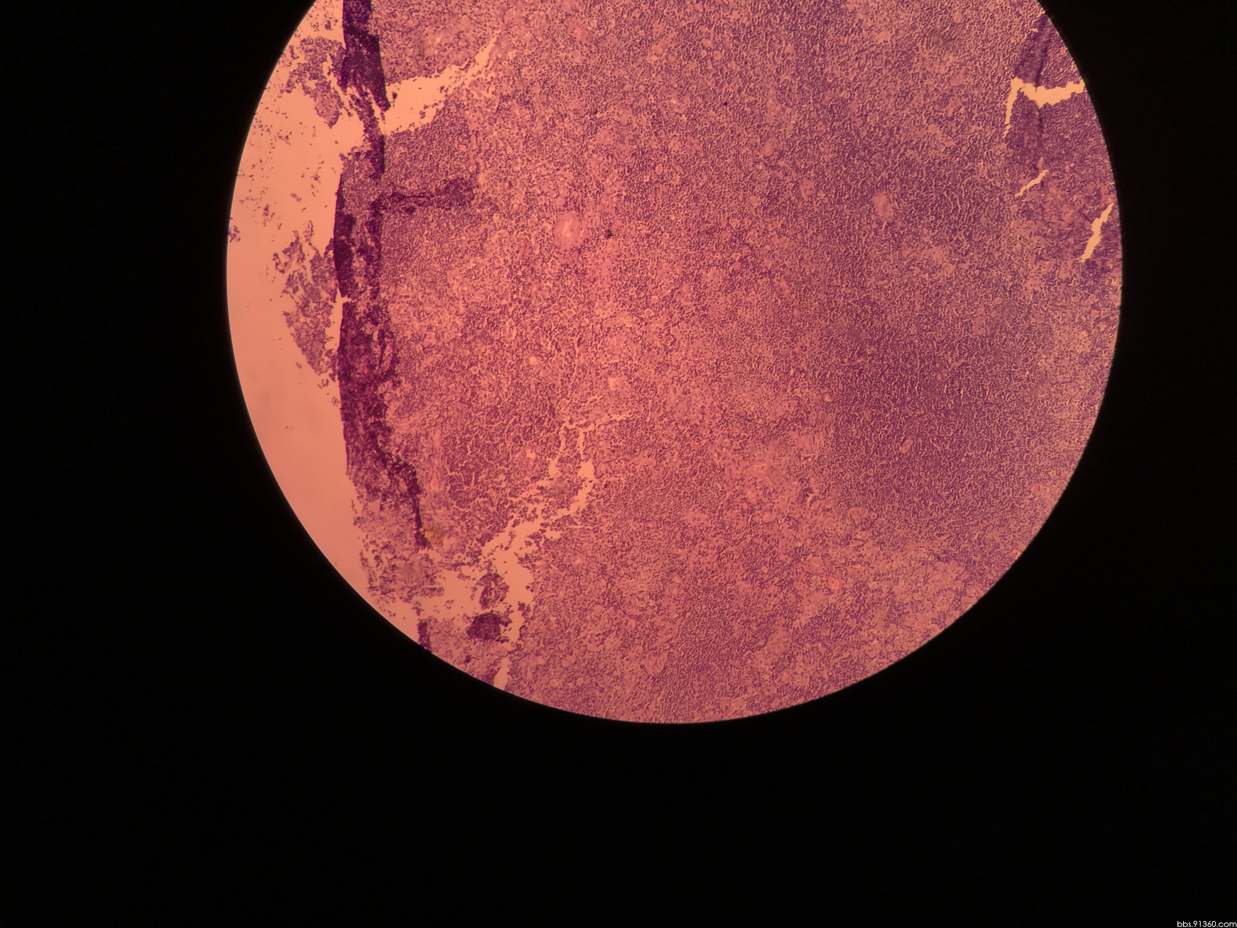 球结膜肿物0.7x0.7x0.2cm,男35岁.大家给看看