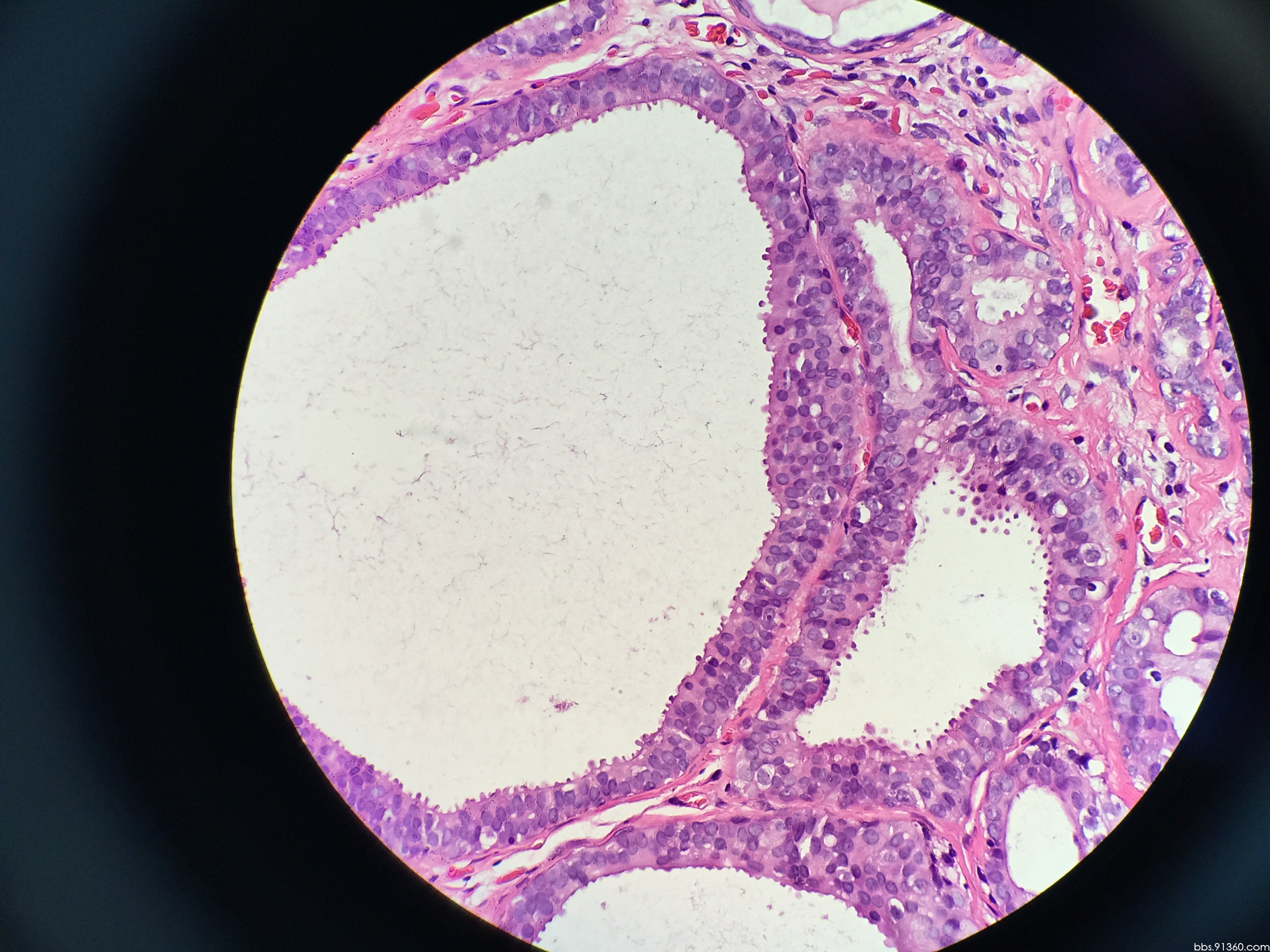 左乳低回声结节病例8.10【91360乳腺沙龙病例40】