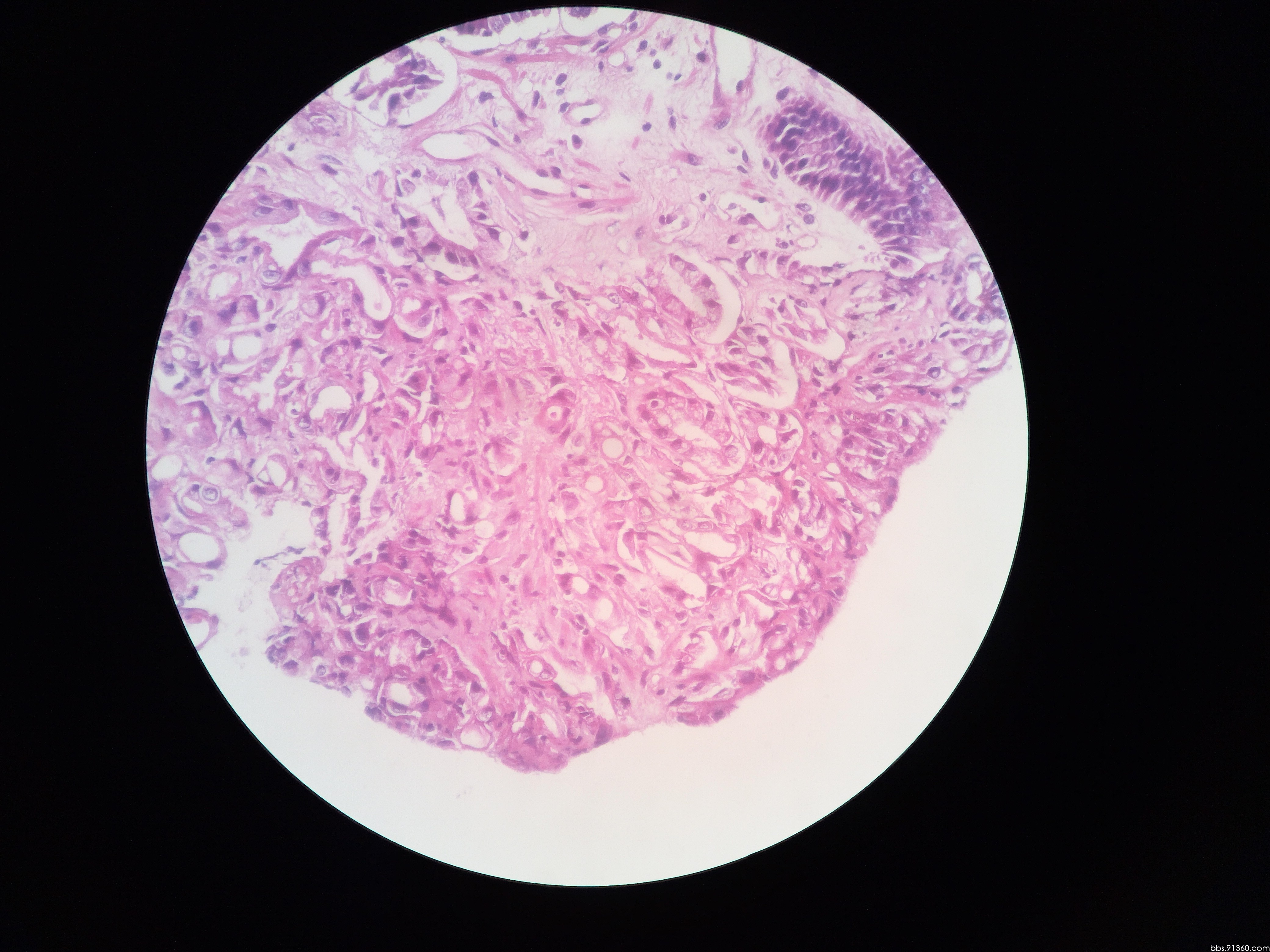 胃镜组织,0.3x0.3,83岁 - 消化系统 - 91360病理论坛