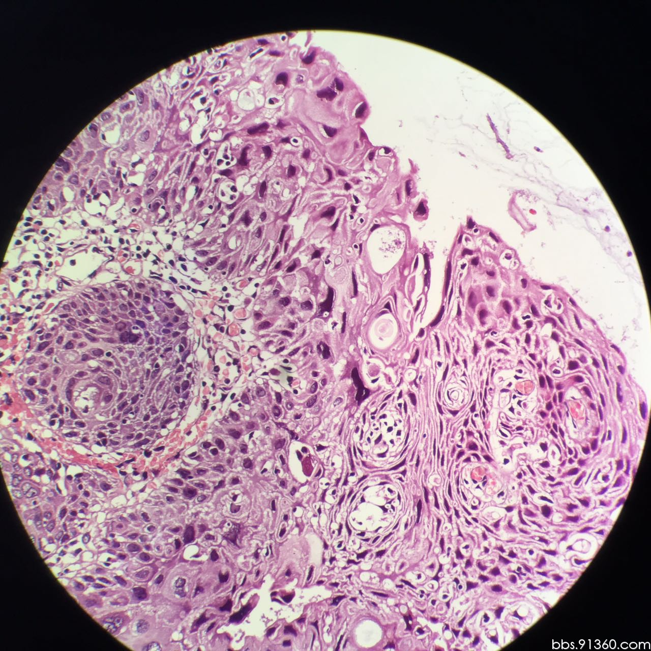 病例1 子宫肌壁间肌瘤-妇产超声读片-医学