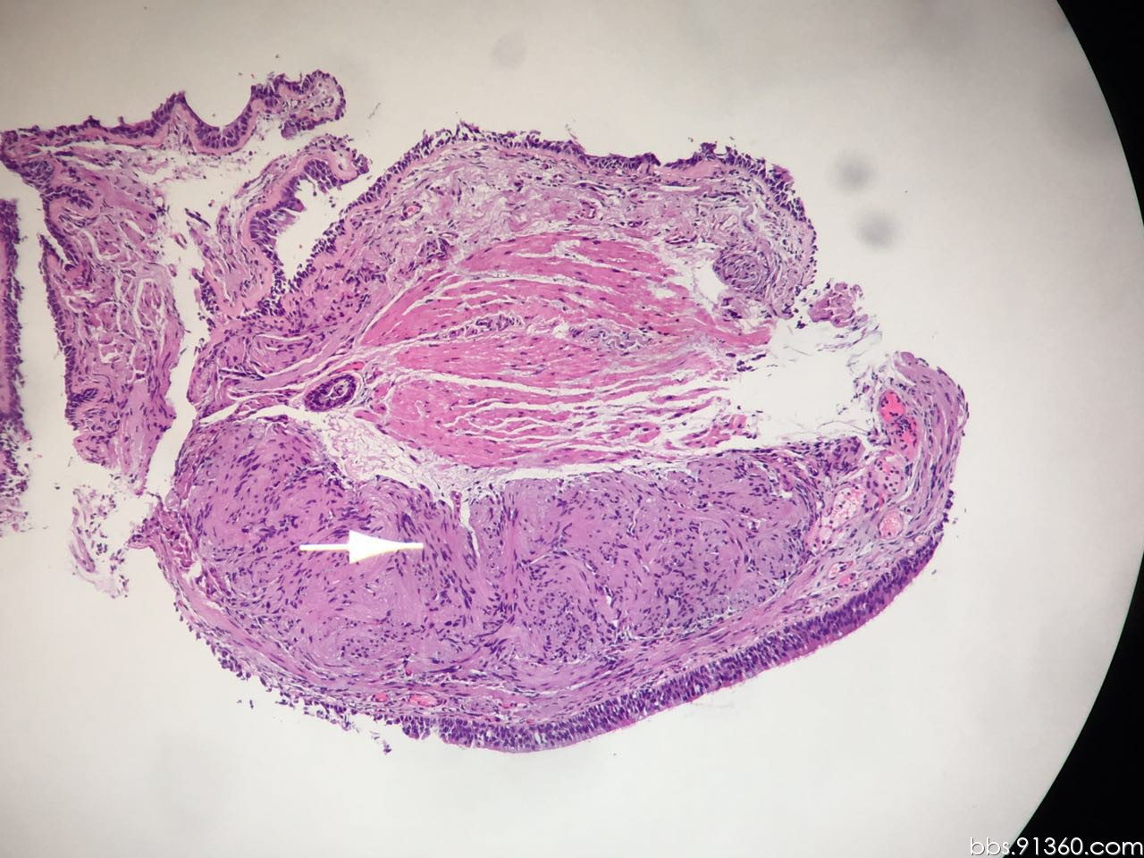 神经鞘瘤病例【胸部等器官论坛病例99】 - 呼吸系统 - 91360病理论坛