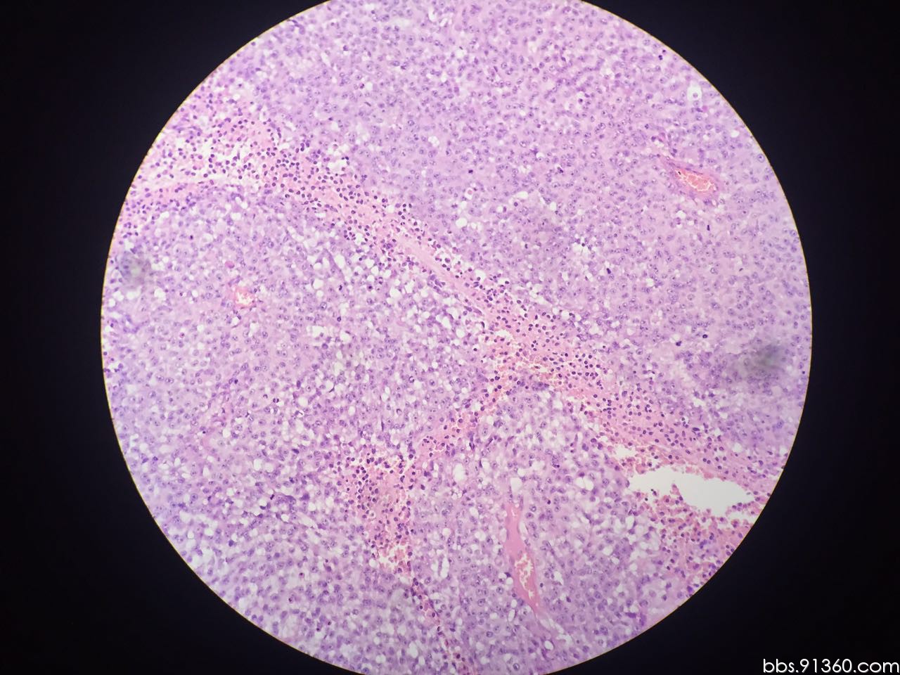 左大腿根部 精原细胞瘤 9.8【91360软组织与骨沙龙病例94】